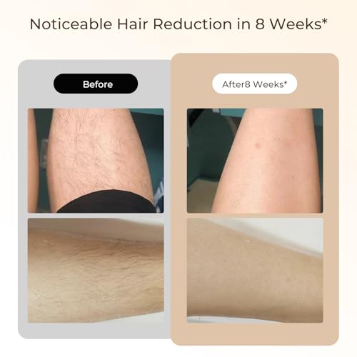 Laser Hair Removal IPL Laser Hair Removal for Women and Men Permanent, 999999 Flashes, At-Home Hair Removal Device for Facial Legs Arms Whole Body Use (White Gold)