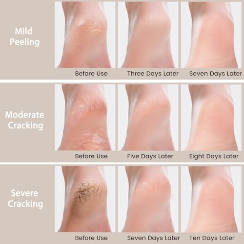 Urea Cream 40 Percent -Pro Foot & Hand Cream, for Dry, Cracked Heels, Feet, Knees, Elbows, and Hands,Callus Remover,Maximum Strength Urea Lotion for Softening and Moisturizing