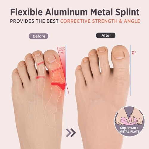 PEDIGOO Bunion Corrector for Women 2pc, Non-Slip Bunion Toe Separator, Hallux Valgus Relief for Day/Night Support (Beige)