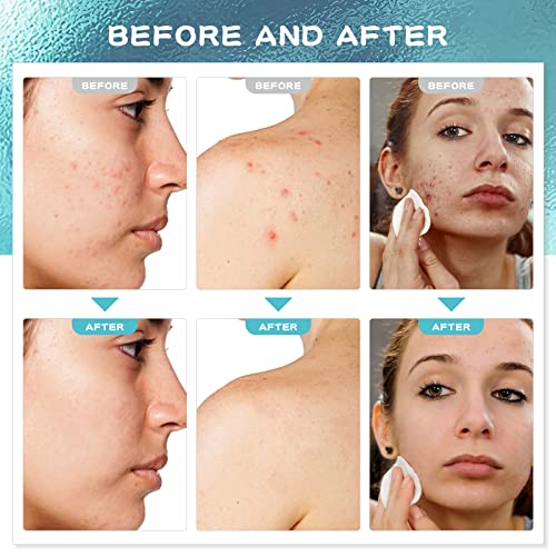 Paradise Emerald Cystic Acne Spot Treatment, Hormonal Acne Treatment for Face,Back and Body, with Salicylic Acid and Tea Tree Oil, Pimple Advanced Acne Cream for Teens & Adults