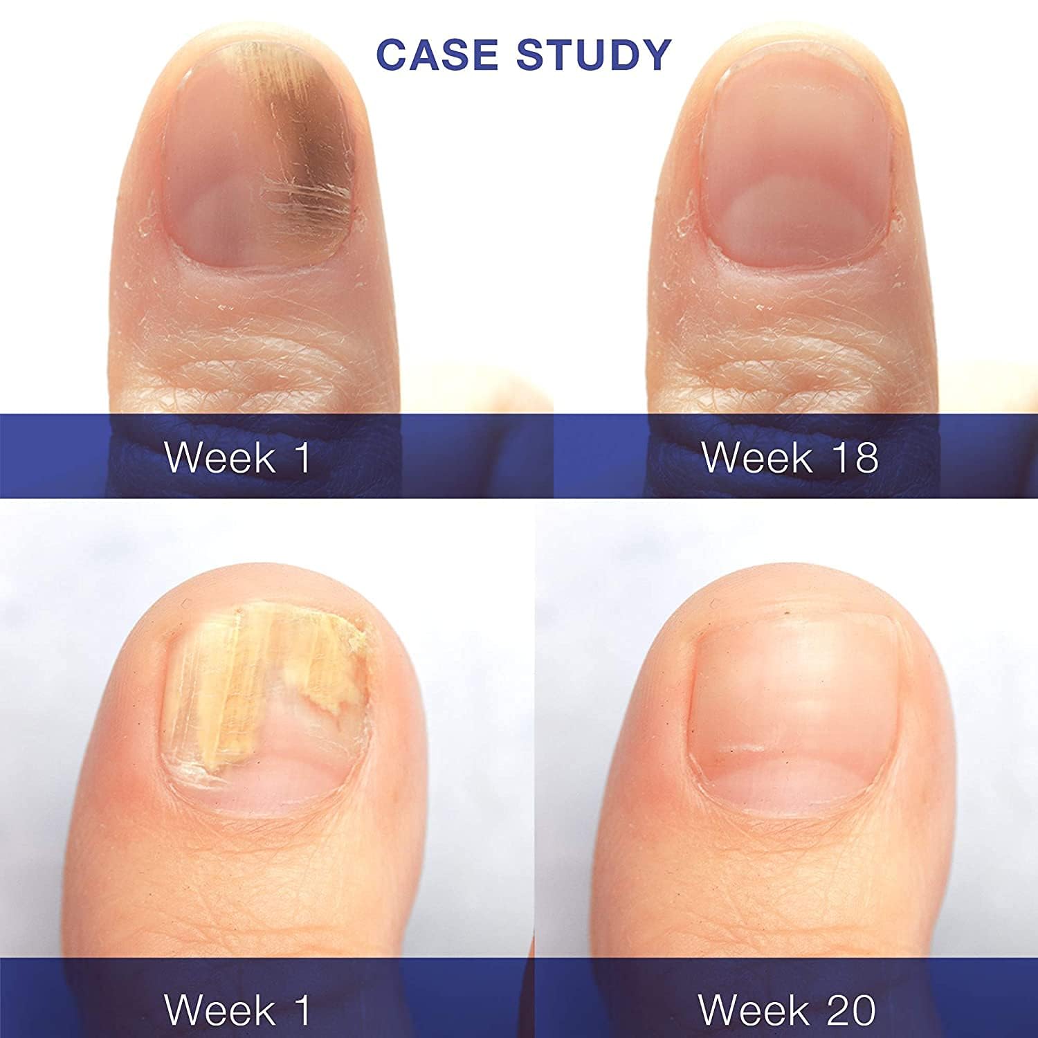 Toenail Fungus Revitalizer Tough on Nails: Toenail Refresher Liquid for Discolored Nails