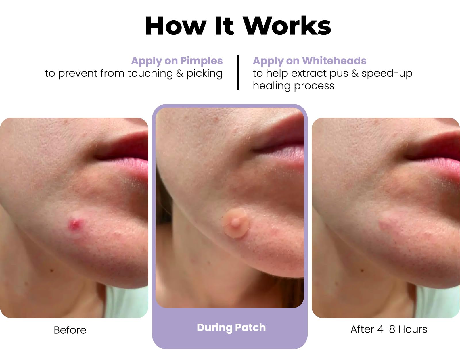ROSELYNBOUTIQUE Pimple Patches for Face 300 Counts 4 Sizes - Hydrocolloid Acne Patches with Tea Tree Oil, SalicylicAcid, CICA Skin-Friendly