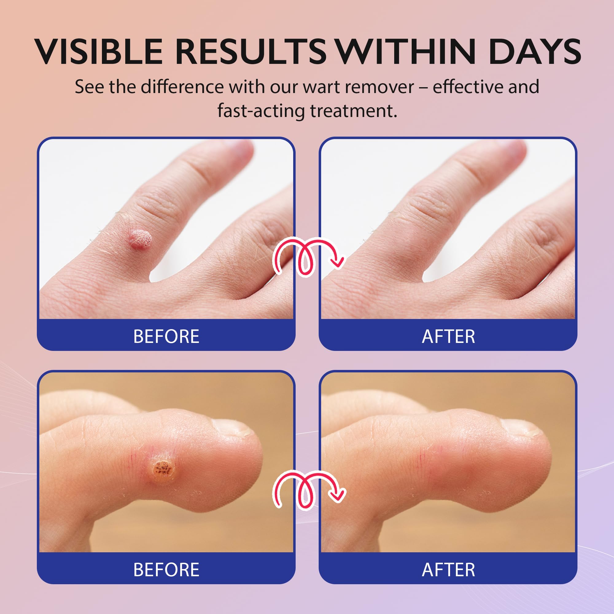 Fast-Acting Wart Remover for Plantar Wart: Salicylic Acid Wart Remover Freeze Off for Men Women - Wart Removal for Plantar Wart, Genital Wart, H Warts, Common Wart, Flat Wart, Corn, Callus, Feet Warts