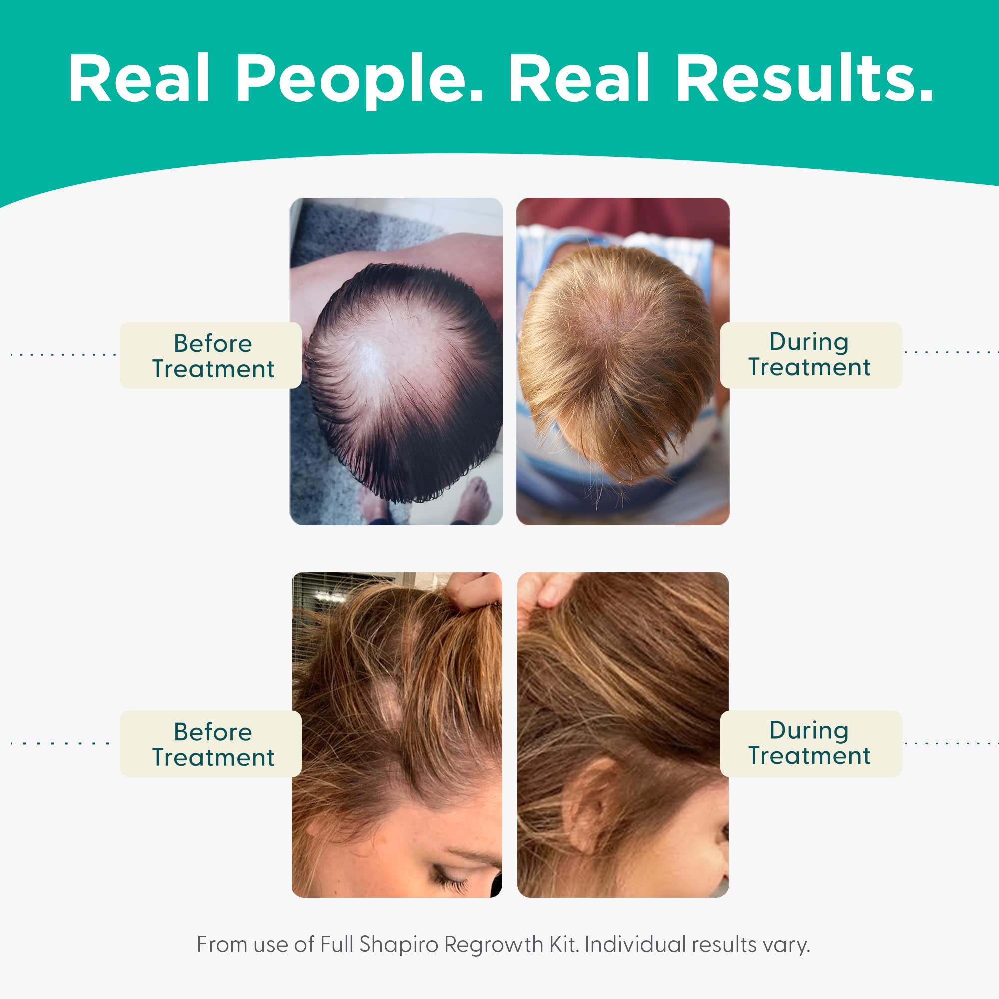 Shapiro MD Hair Growth Experts Hair Loss Leave-In Daily Foam, DHT Fighting Vegan Formula for Thinning Hair Developed by Dermatologists, Experience Healthier, Fuller, 2 Month Supply