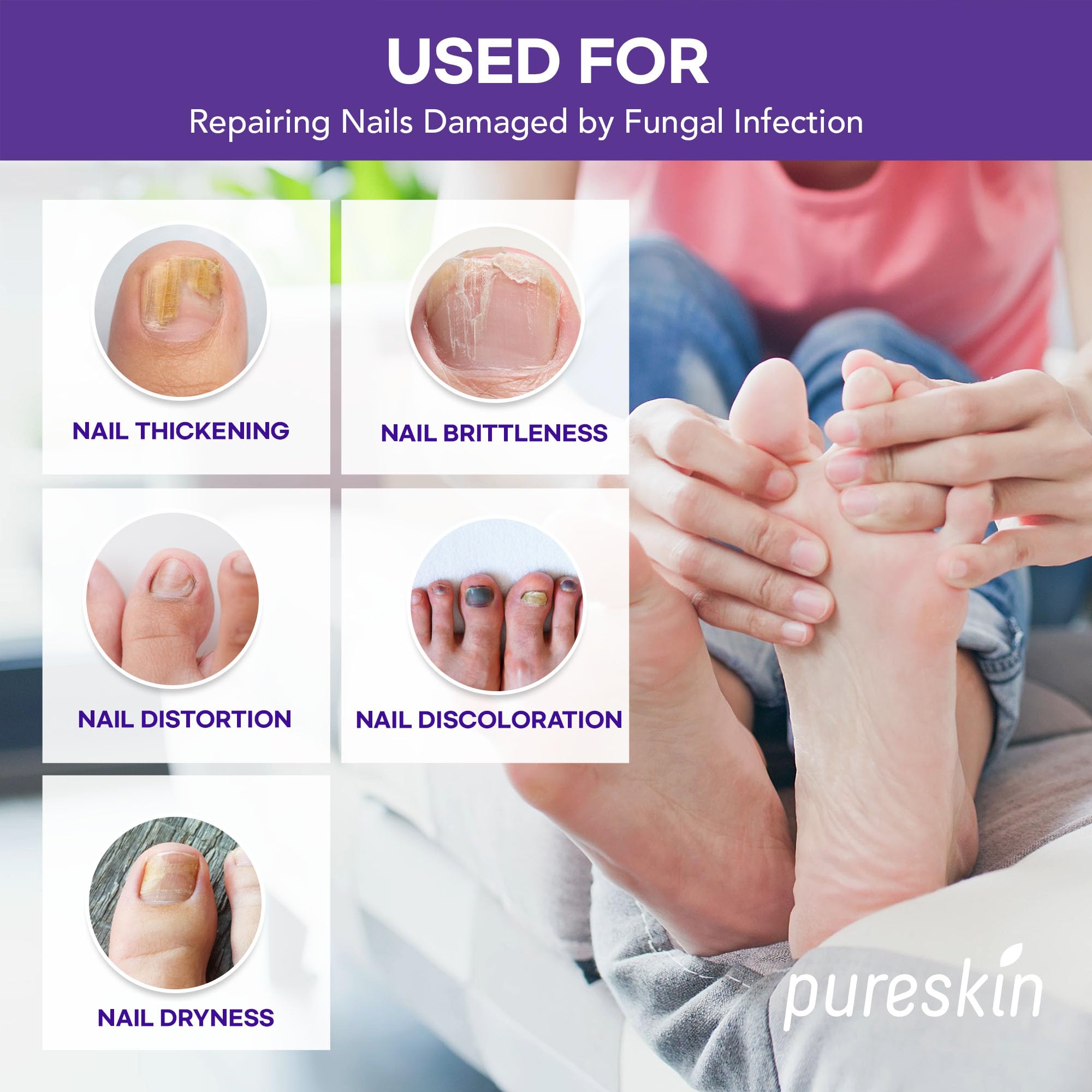 Extra Strength Toenail Fungus Treatment Patches: Nail Fungus Treatment for Toenail Fingernails - Fungal Nail Patches Nail Repair Patches - 8-Hour Nightime Nail Renewal Patches - 21Patches