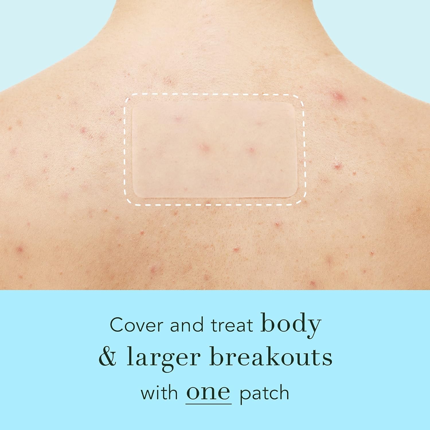 Rael Pimple Patches, Miracle XL Spot Control Cover - Hydrocolloid Acne Patches for Face, Zit and Blemish Spot, Back and Body, for All Skin Types, Vegan, Cruelty Free (6 Count)