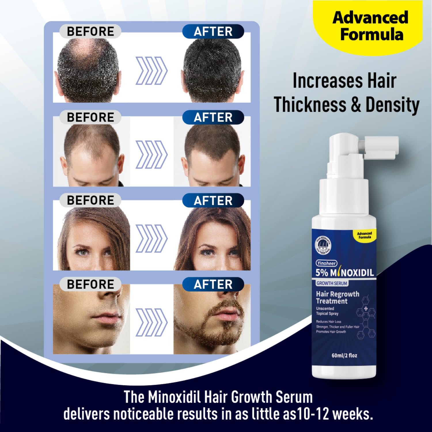 5% Minoxidil Spray for Men and Women, Extra Strength Hair Regrowth Treatment for Men and Women to Combat Hair Loss & Thinning Hair, Topical Solution, No Mess Sprayer, 2-Pack