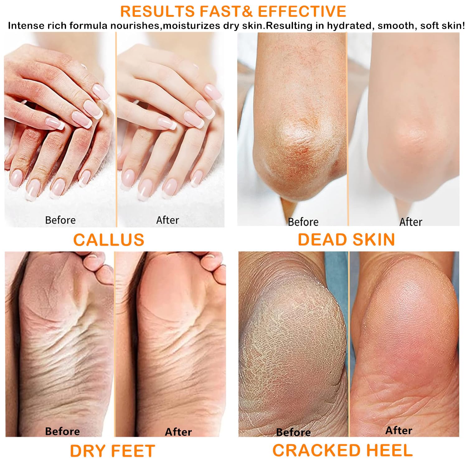 Urea Cream 40 Percent Foot Cream for Dry Cracked Heel and Feet Cracked Heel Repair 40% Urea Cream Balm for Feet Hand Moisturizing Lotion Dead Skin Remover Softener Feet Care Treatment For Women Men