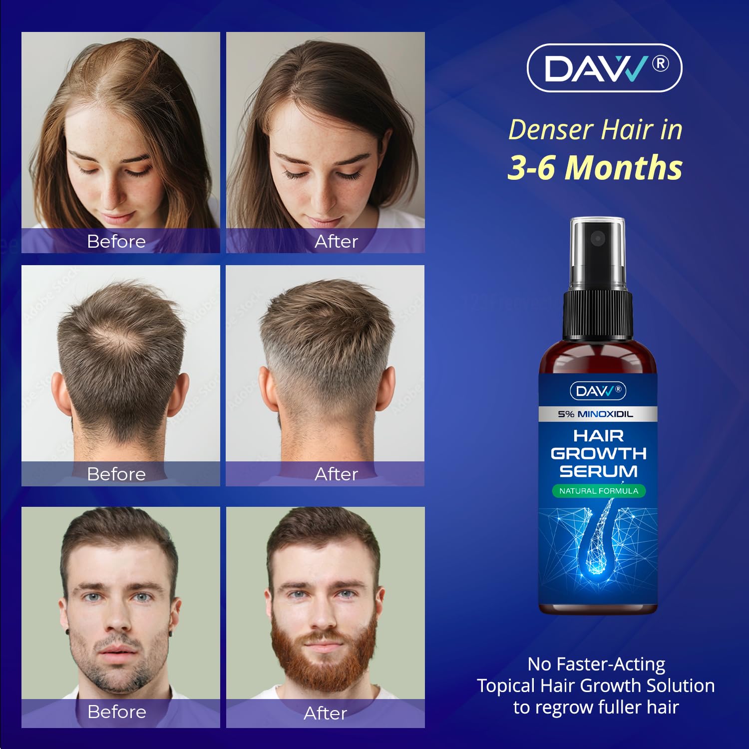 5% Minoxidil for Women and Men: Minoxidil Spray - Minoxidil for Men Hair - Hair Growth Products - Hair Growth Serum with Rosemary - Extra Strength Hair Loss Solution - Faster Stronger Thicker - 60ml