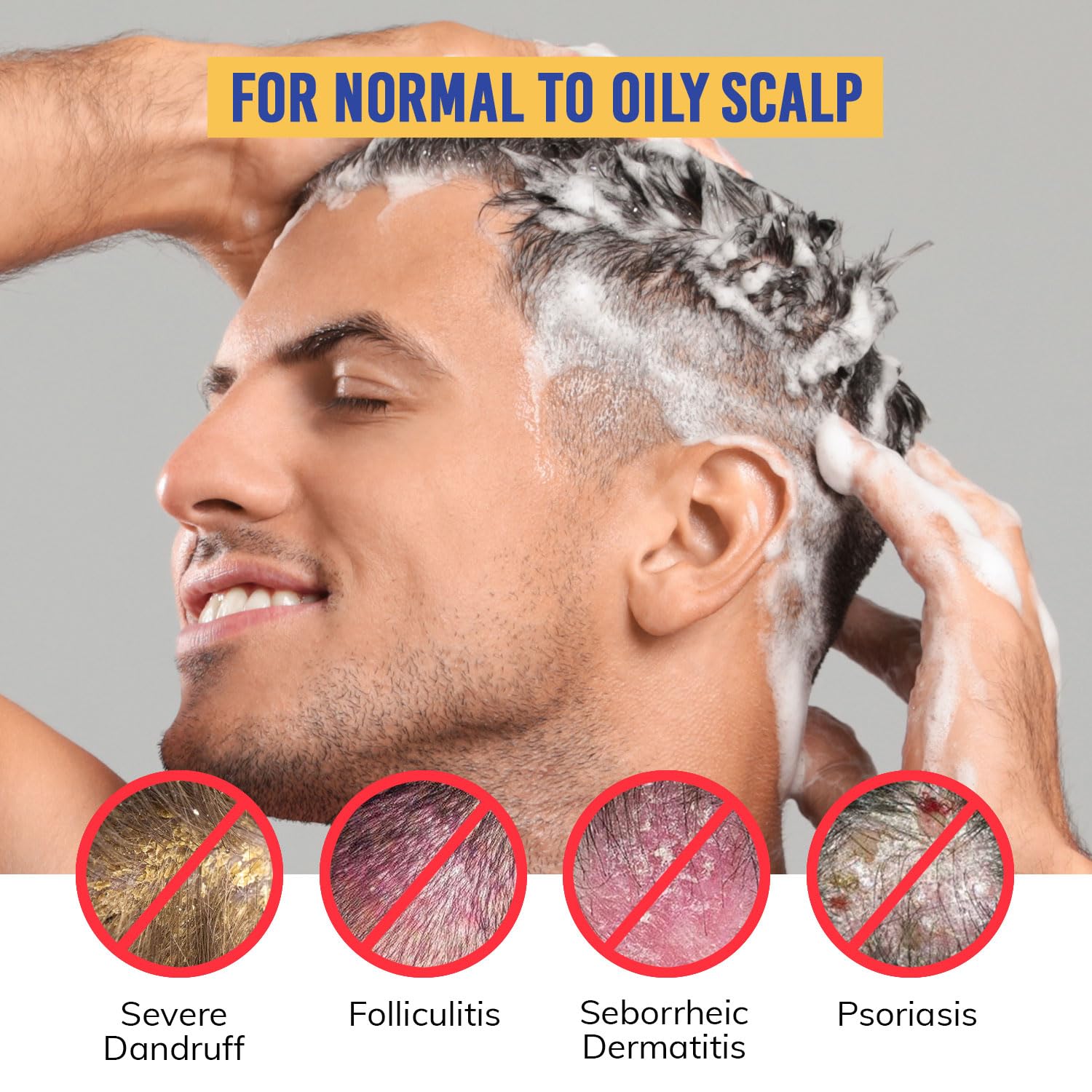 Seborrheic Dermatitis Folliculitis Dandruff Shampoo - Anti Fungal Medicated Shampoo for Healthy Scalp with Selenium Sulfide & Botanical Extracts - Flakes Itchy and Oily Scalp Relief Stop Hair Loss