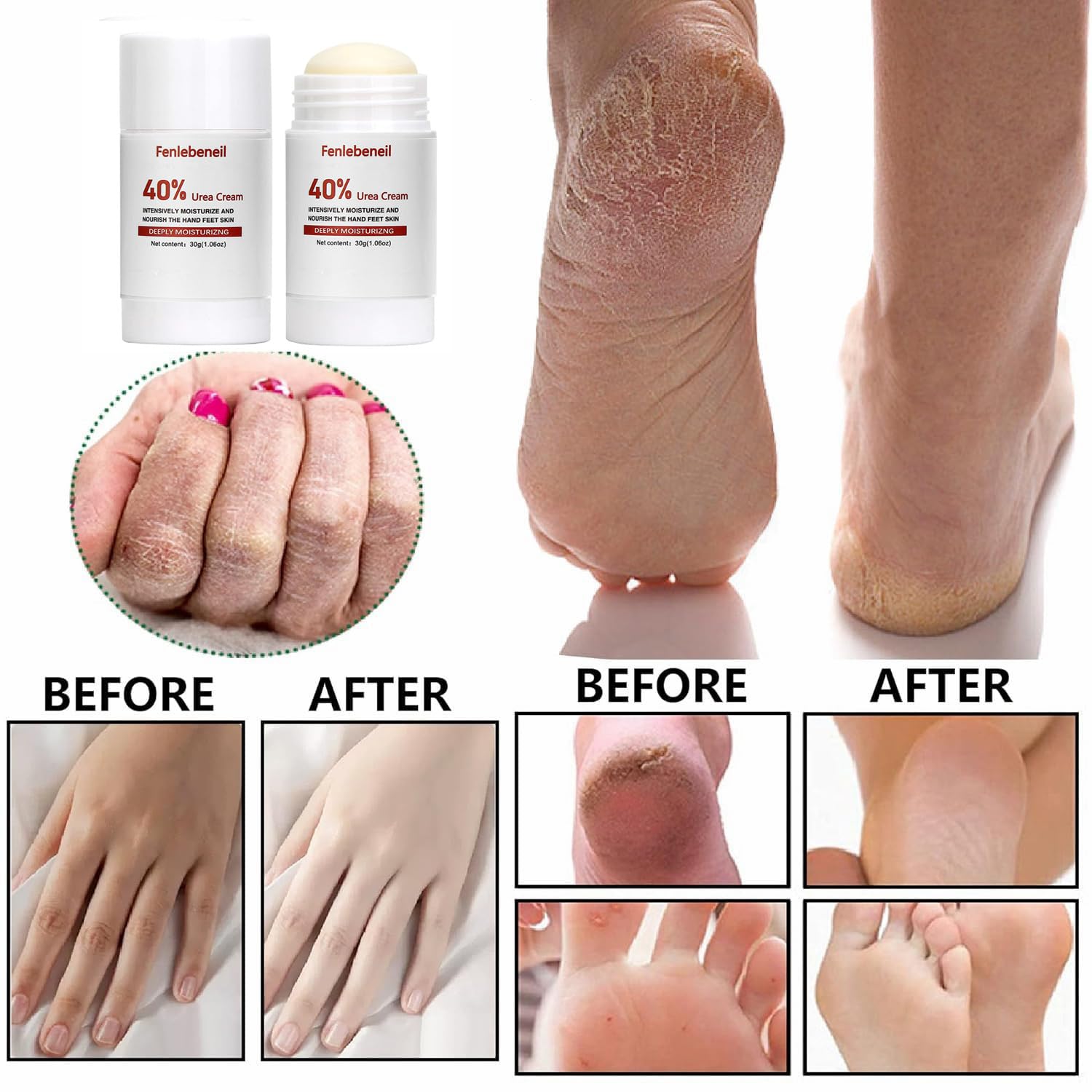 Urea Cream 40 Percent Foot Cream for Dry Cracked Heel and Feet Cracked Heel Repair 40% Urea Cream Balm for Feet Hand Moisturizing Lotion Dead Skin Remover Softener Feet Care Treatment For Women Men