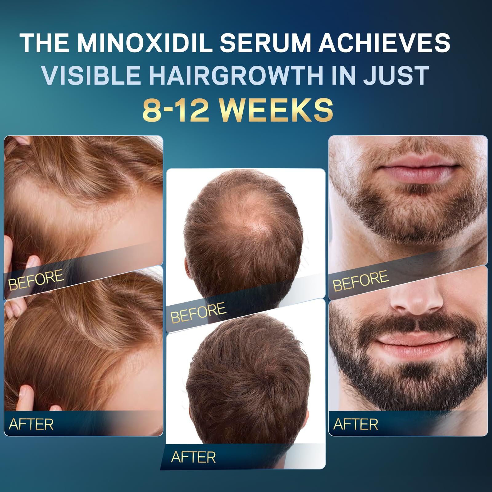 5% Minoxidil for Men and Women Hair Growth, AMOADO Minoxidil Serum with Rosemary&Biotin for Hair Regrowth, Beard Growth, Extra Strength,Thicker, Fuller Hair -2fl.oz