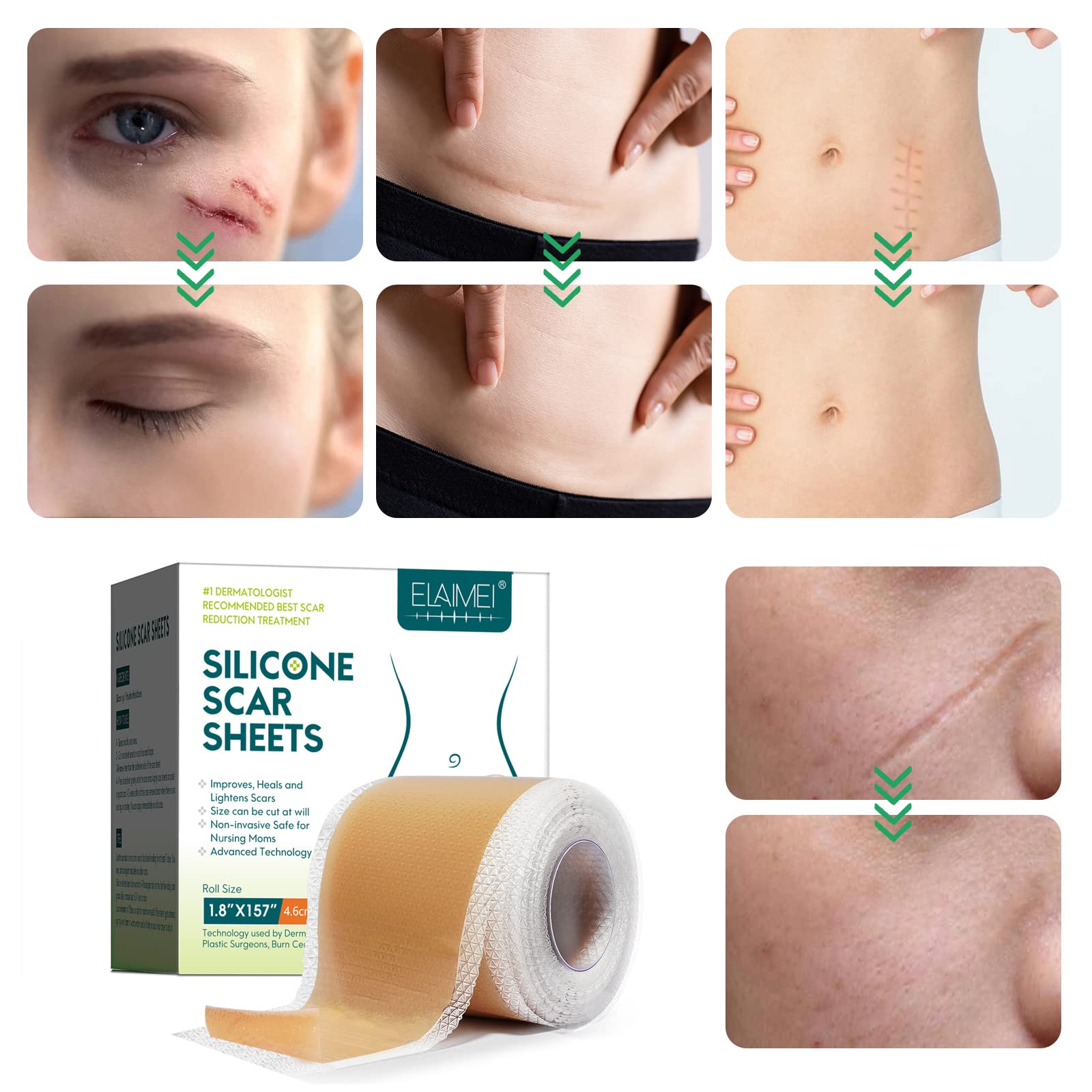 Silicone Scar Sheets(1.8” x 157”Inch- 4M), Scar Tape, Scar Strips, Medical Grade, Scar Remover, C-Section, Surgery, Keloid, Tummy Tuck, Scar Patch.