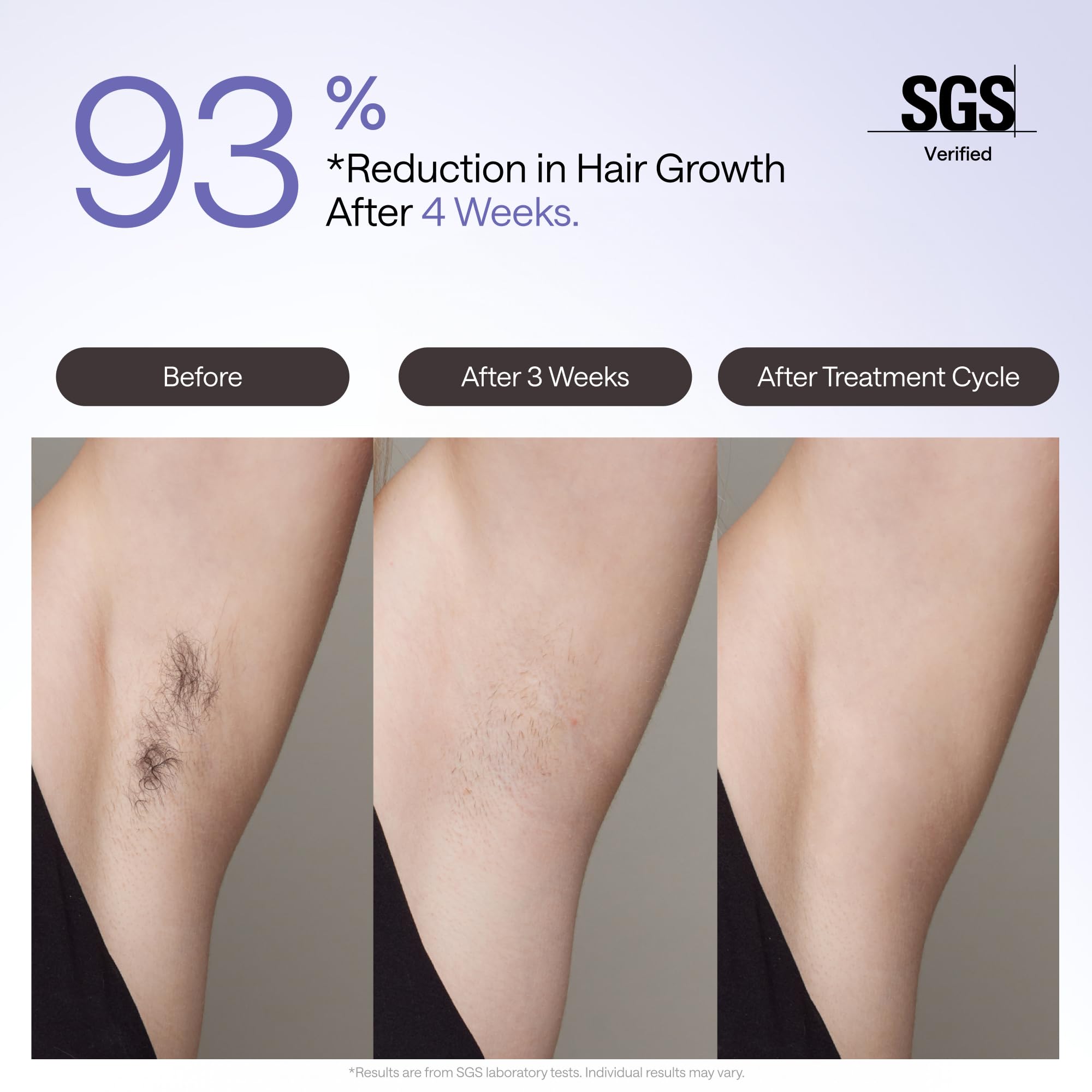 Ulike Laser Hair Removal Device Air 4 Ipl Gift for Women and Men, Ice Cool and Permanent Hair Reduction for Nearly Painless, USHR Mode Hair Removal in 10mins from Home
