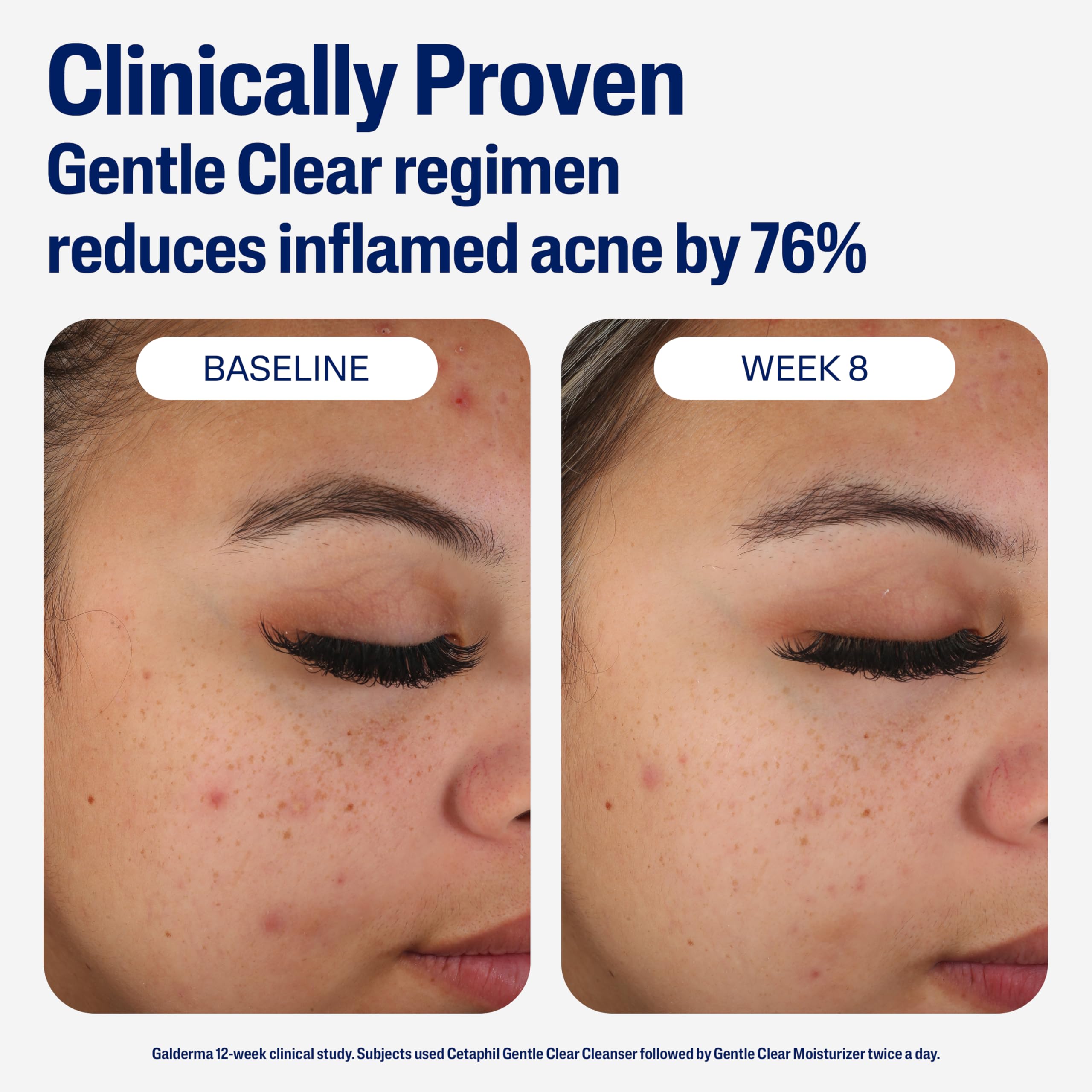 Cetaphil Face Moisturizer, Gentle Clear Mattifying Acne Moisturizer With 0.5% Salicylic Acid, Hydrates and Treats Sensitive Acne Prone Skin, Skin Care for Sensitive Skin, 3oz