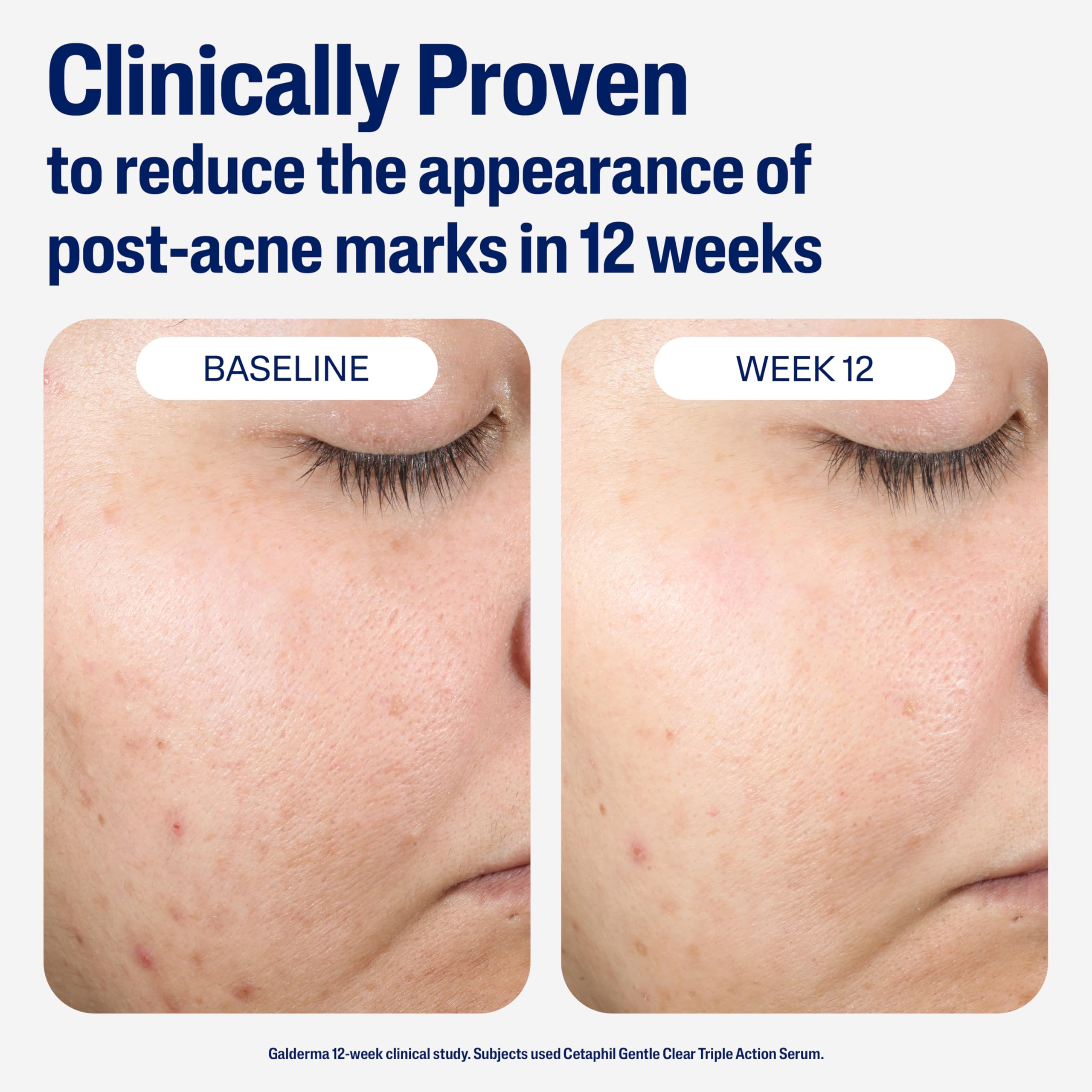 CETAPHIL Gentle Clear Repairing Post-Acne Serum, Retinol Alternative, Oil Free Serum for Sensitive Skin, 1 Fl Oz, Bakuchiol, Improves Skin Tone & Post-acne Marks, Dermatologist Recommended Brand