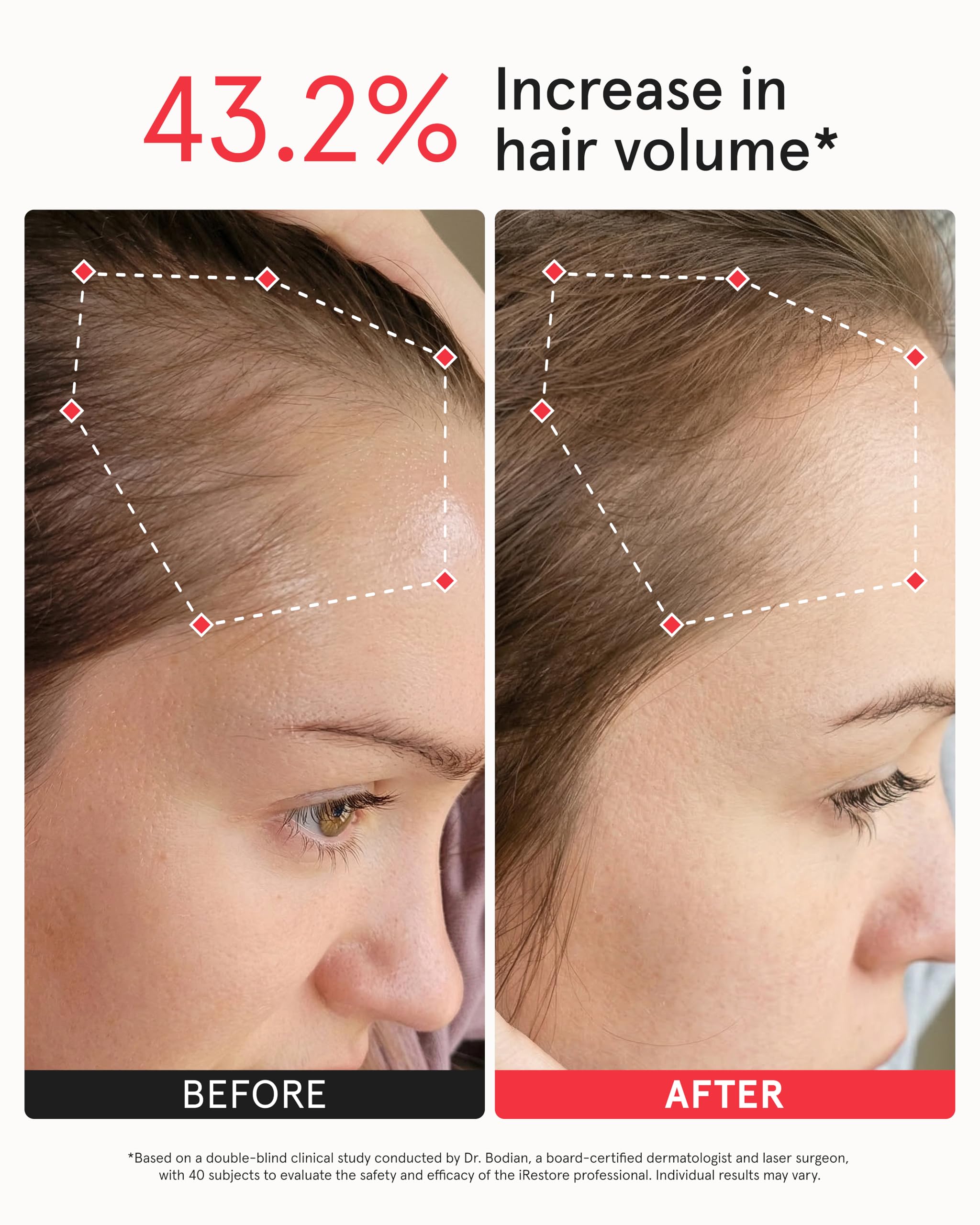 iRestore Professional Laser Red Light Therapy for Hair Growth System - FDA Cleared Hair Loss, Hair Thinning & Alopecia Treatment for Men & Women - 282 Lasers & LEDs