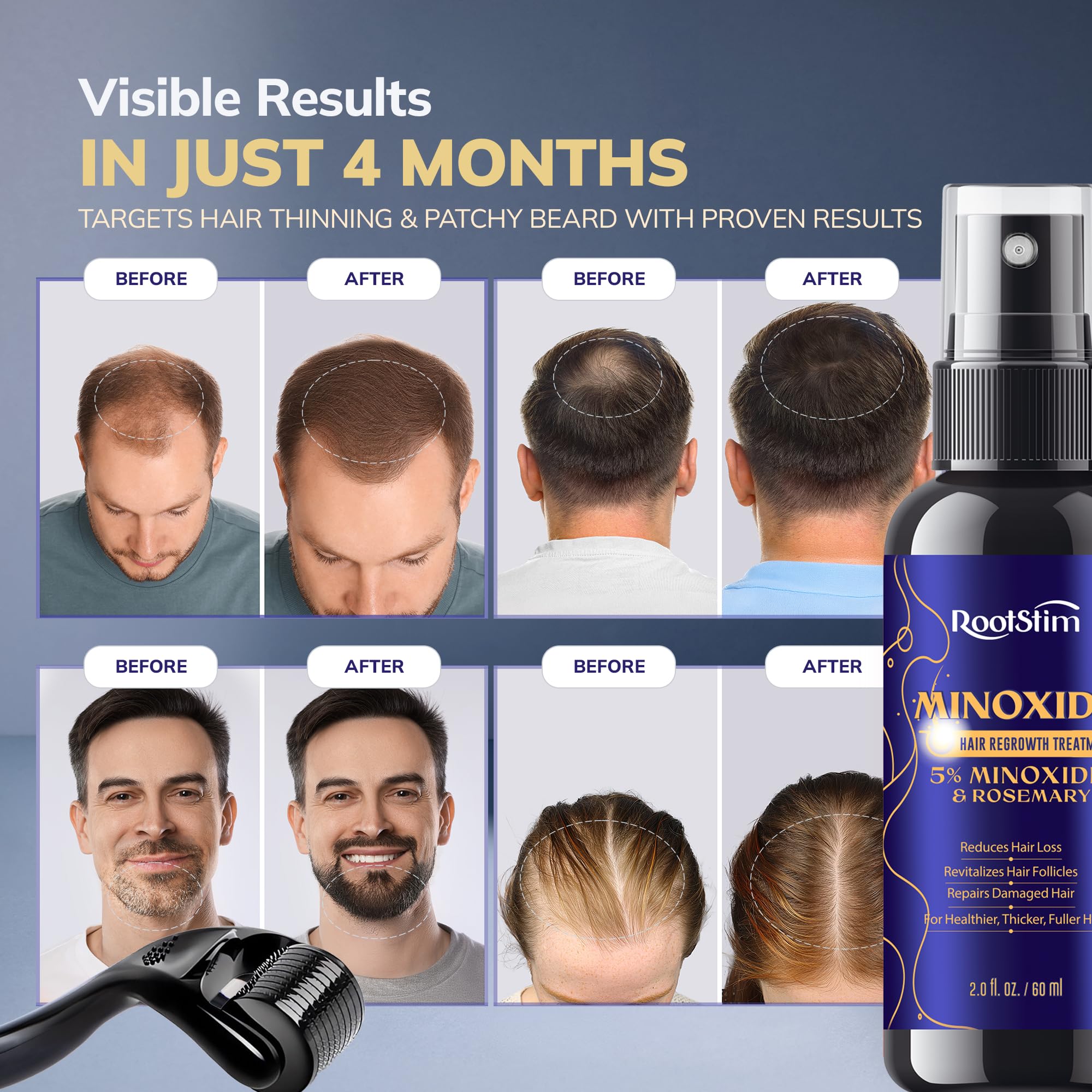 5% Minoxidil Hair Regrowth Bundle for Men and Women – Supports Thicker, Fuller Hair & Beard – 120 mL