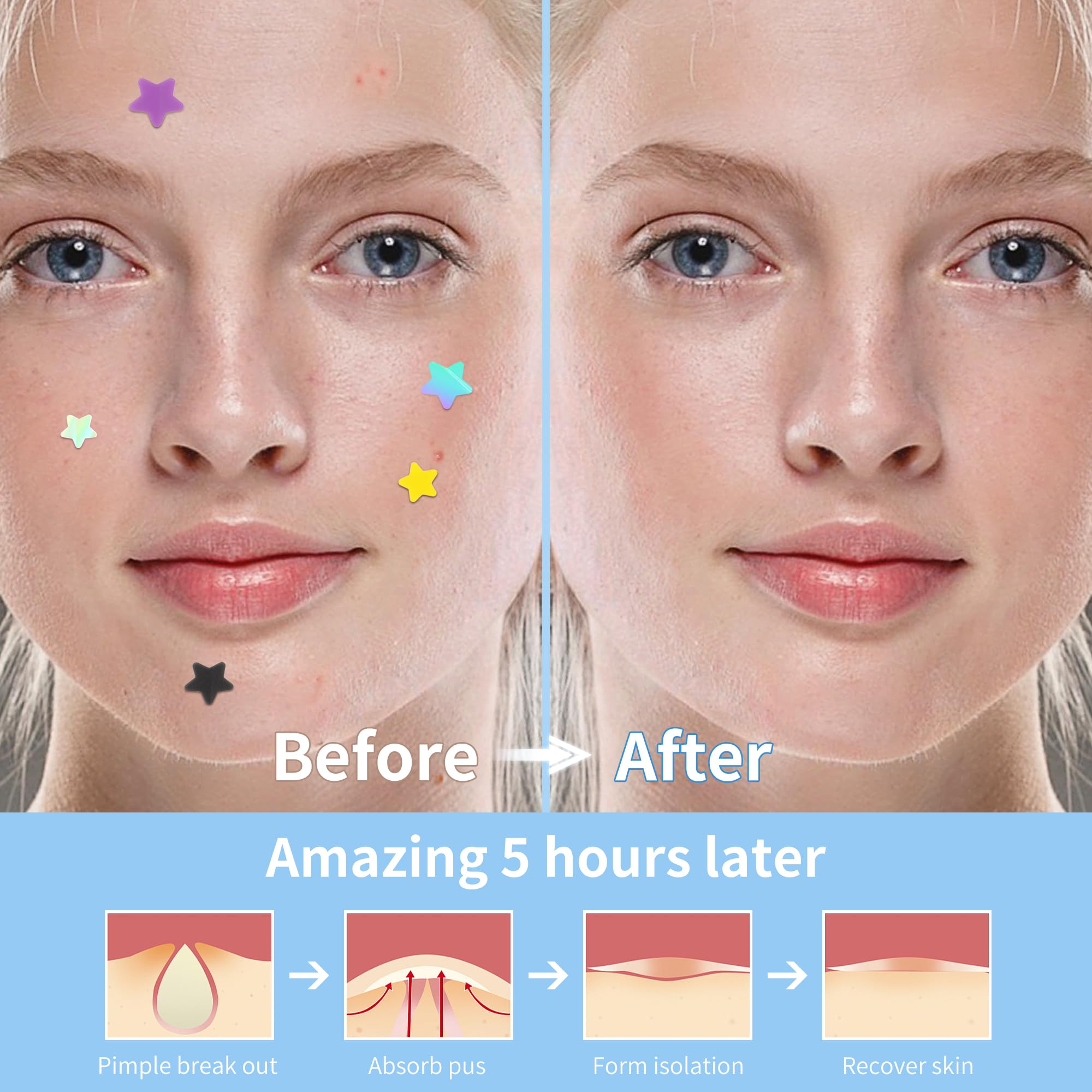 Daolyo Pimple Patches for Face, 3 Size 280 Counts Acne Patches, Cute Star Pimple Patches with Salicylic Acid, Tea Tree Oil & Calendula Oil, Colorful Hydrocolloid Patches Zit Patches Pimple Stickers