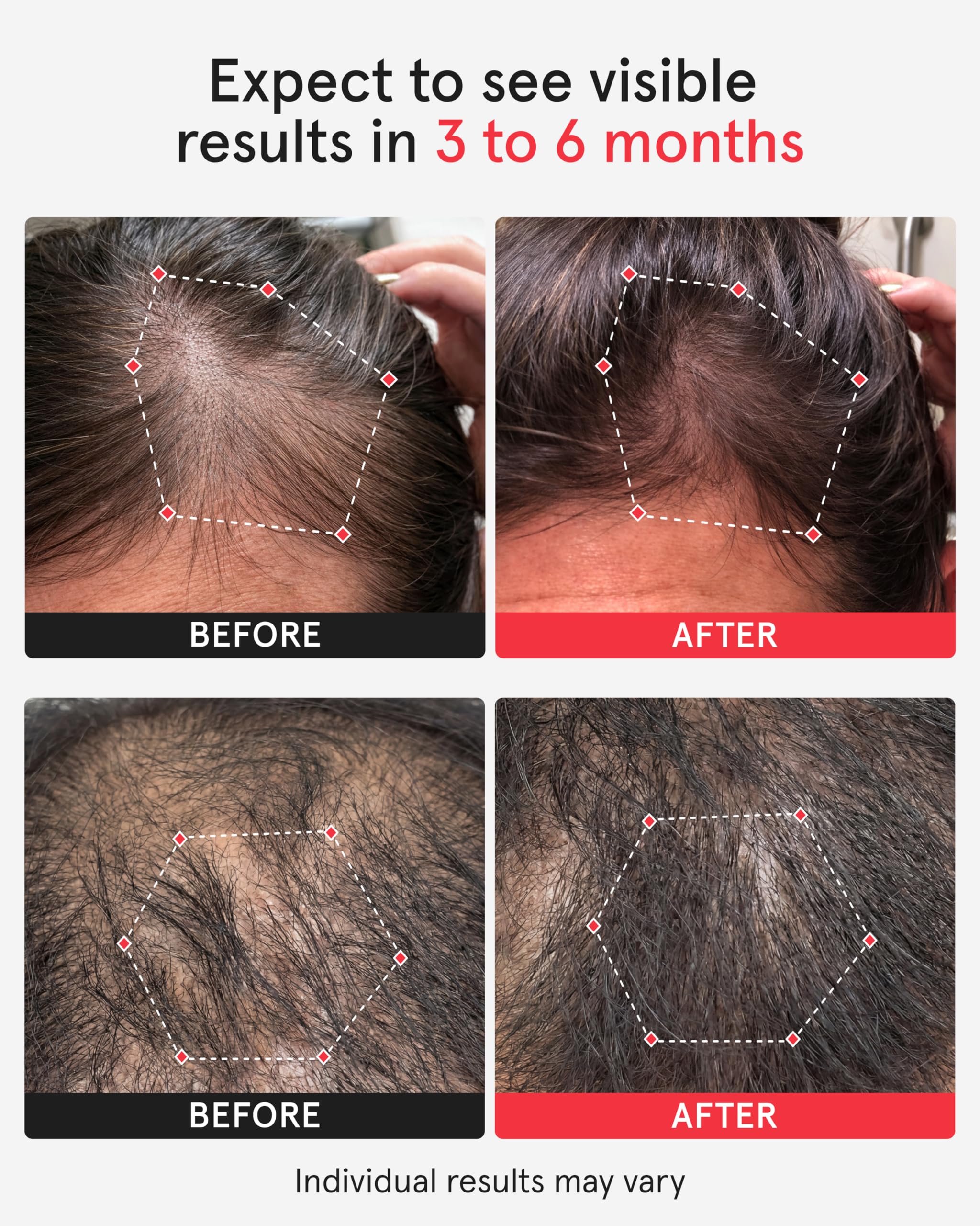 iRestore Professional Laser Red Light Therapy for Hair Growth System - FDA Cleared Hair Loss, Hair Thinning & Alopecia Treatment for Men & Women - 282 Lasers & LEDs