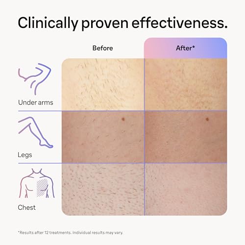 Braun SMART IPL Long-lasting Laser Hair Removal Device for Women & Men, Skin i·Expert, Home Hair Removal, Free App, Vanity Case, Venus Razor, 3 Smart Heads, Alternative for Laser Hair Removal, PL7243