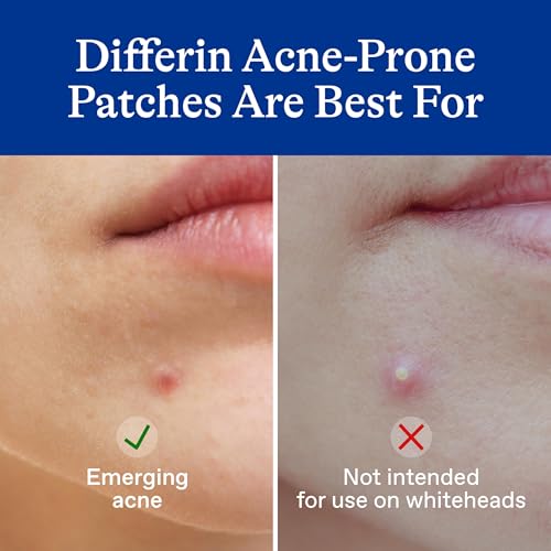 Differin Acne Patches, Pimple Patches for Acne Prone Skin, Formulated with Salicylic Acid and Centella, Fast Triple Action Power Patch for Day & Night, Dermatologist Tested, 36 Count_