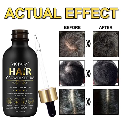 5% Minoxidil for Men and Women - Biotin Hair Growth Serum & 5% Minoxidil Treatment for Stronger Thicker Longer Hair – Natural Hair Growth Thickening Treatment - Stop Thinning & Hair Loss-1Month supply