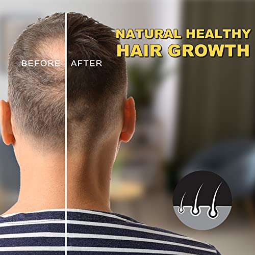 5% Minoxidil for Men and Women - Biotin Hair Growth Serum & 5% Minoxidil Treatment for Stronger Thicker Longer Hair – Natural Hair Growth Thickening Treatment - Stop Thinning & Hair Loss-1Month supply