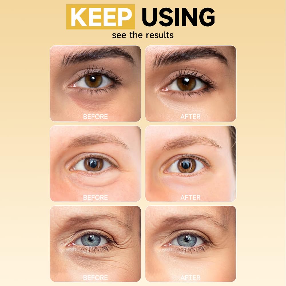 4 Pairs 5% PDRN Under Eye Patches, 6-in-1 Bio-Collagen 360° Eye Patches for puffy eyes, dark circles & Wrinkle | 2% Caffeine, Kojic acid, Retinol, Hyaluronic, Niacinamide | Korean Popular Eye Mask