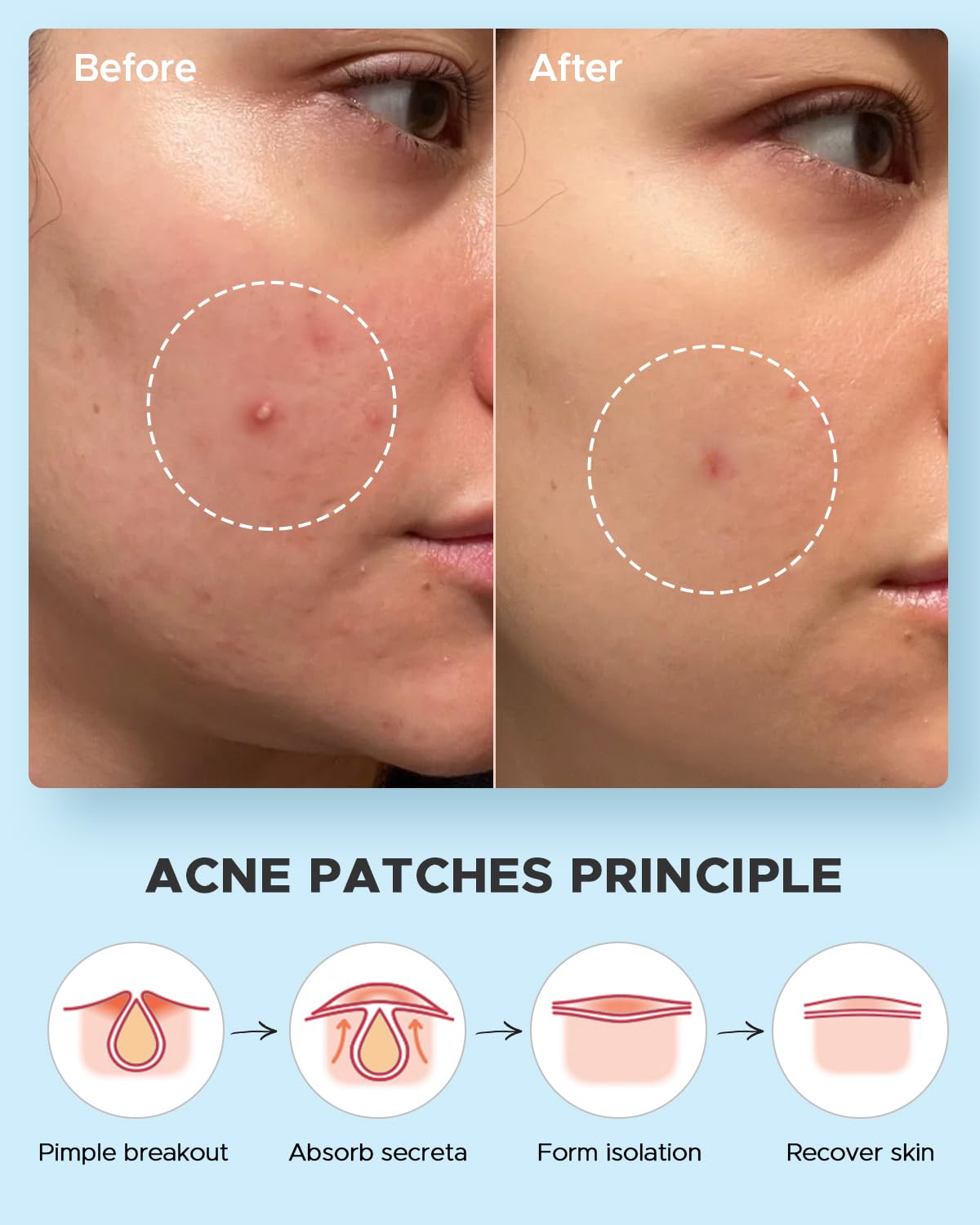 LitBear Acne Pimple Patches- Day and Night 4 Sizes 180 Dots Thin & Thick Hydrocolloid Patches with Witch Hazel, Tea Tree & Calendula Oil, Extra Adhesion for Face Zit Patch Dots