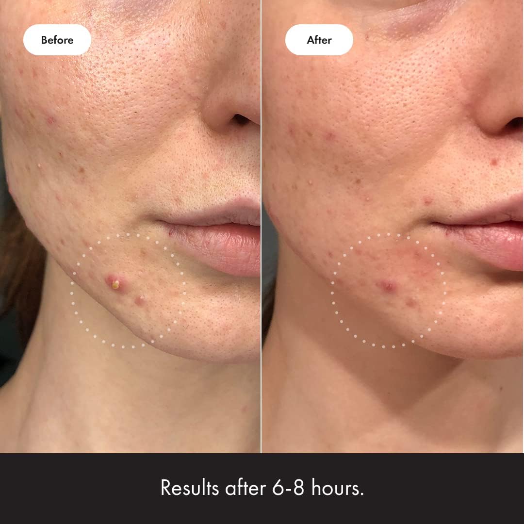 Hero Cosmetics Mighty Patch™ Invisible+ Patch - Daytime Hydrocolloid Acne Pimple Patches for Covering Zits and Blemishes, Ultra Thin Spot Stickers for Face and Skin, Vegan-friendly (39 Count)