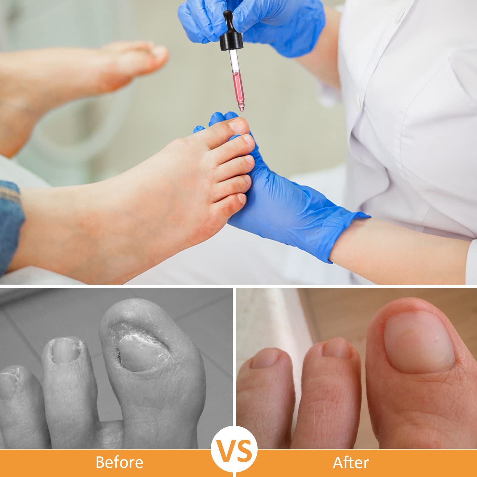 Treatonic Ingrown Toenail Treatment - Ingrown Toenail Pain Reliever and Softener Kit for Easy Trimming with Silicone Gel Toe Caps