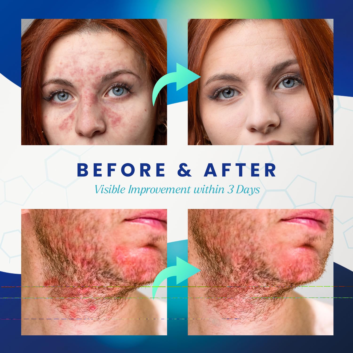 PURESKIN Seborrheic Dermatitis Cream Ketoconazole: Psoriasis Eczema Treatment for Skin Scalp - with Herbal Natural Relief for Flaking Irritated Skin, 3.4 Oz