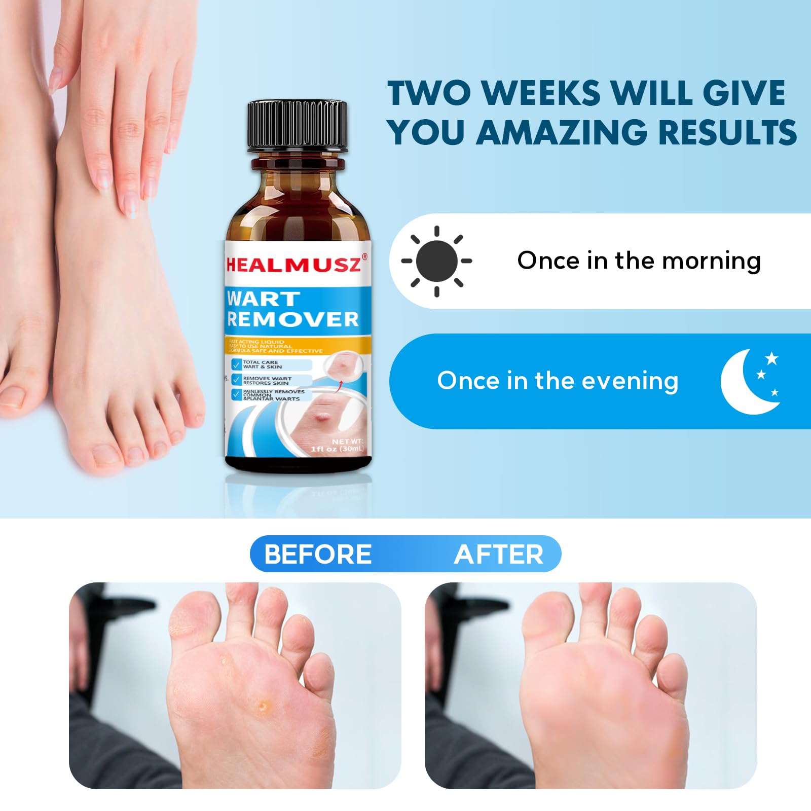 HEALMUSZ Fast-Acting Wart Remover Freeze Off,Salicylic Acid Wart Remover for Men Women-Wart Removal for Plantar Wart,Genital Wart,H Warts,Common Wart,Flat Wart,Corn,Callus 30 ML. (1Pc, Fresh)