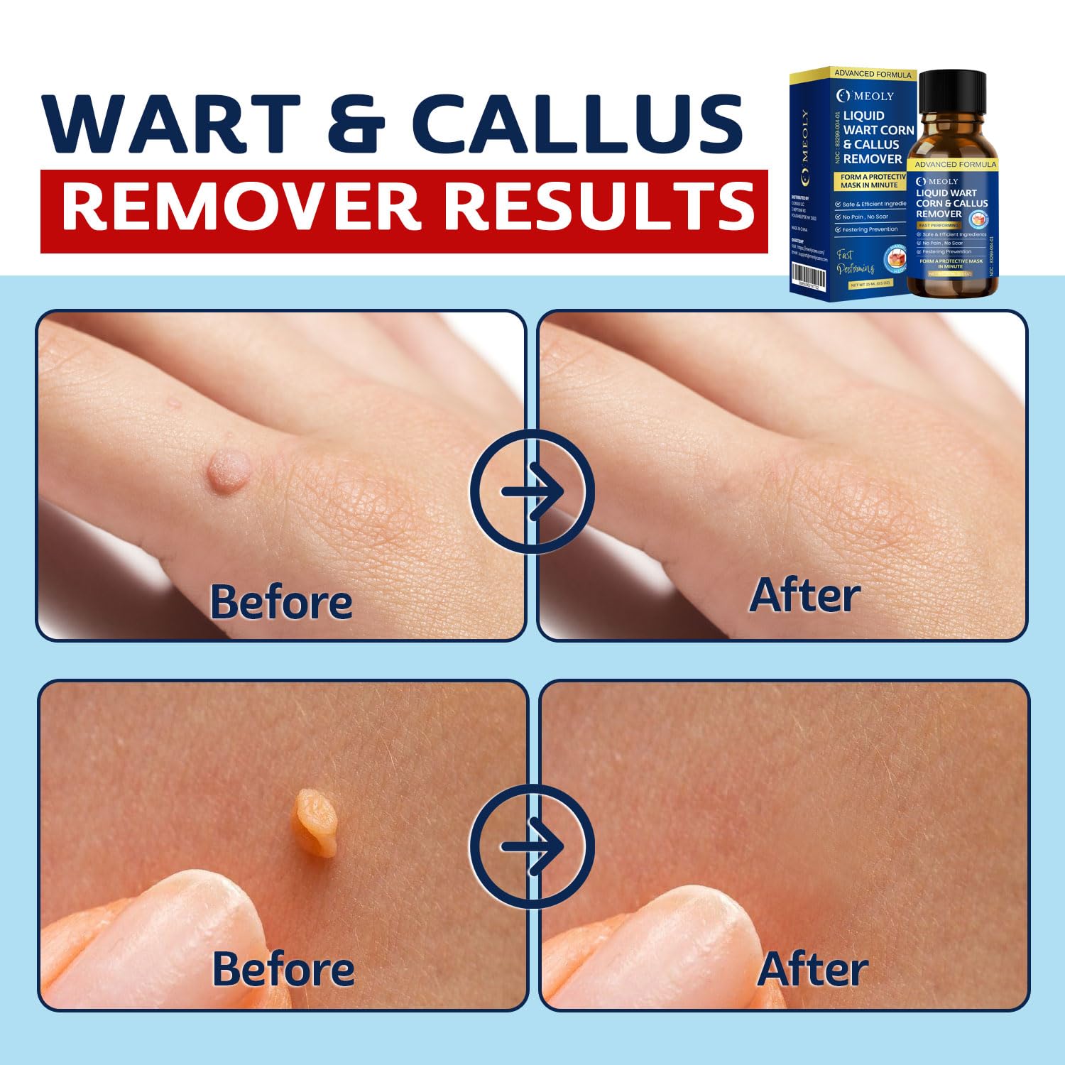 MEOLY Fast-Acting Wart Remover Freeze Off : Salicylic Acid Wart Remover for Men Women - Wart Removal for Plantar Wart, Genital Wart, H Warts, Common Wart, Flat Wart, Corn, Callus 30 ML
