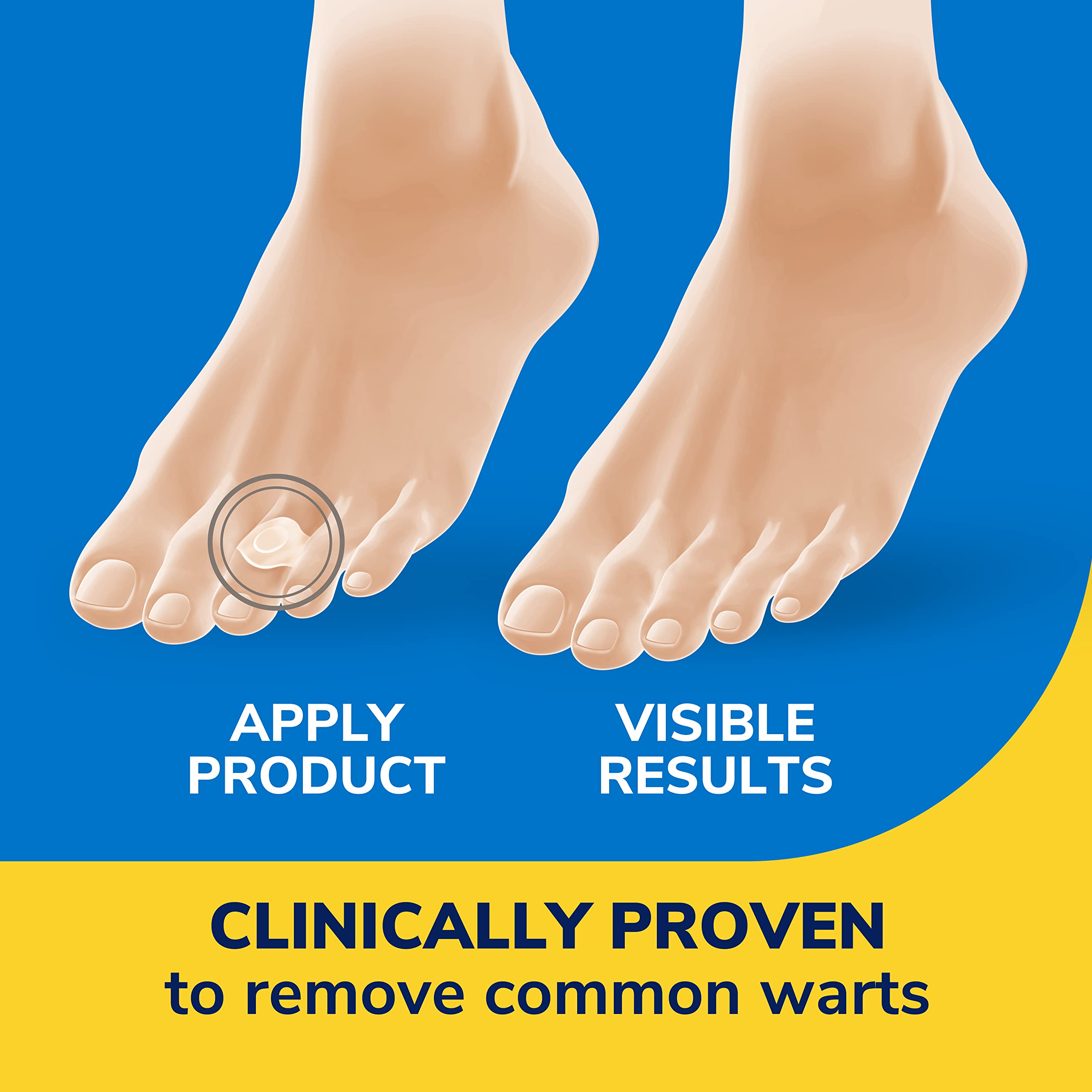 Dr. Scholl's Clear Away WART Remover HYDROGEL Bandage // 12 Discs/9 Cushions, Clinically Proven, Immediate & All-Day Cushioning Pain Relief, Multi-Day Coverage, 12 Treatments