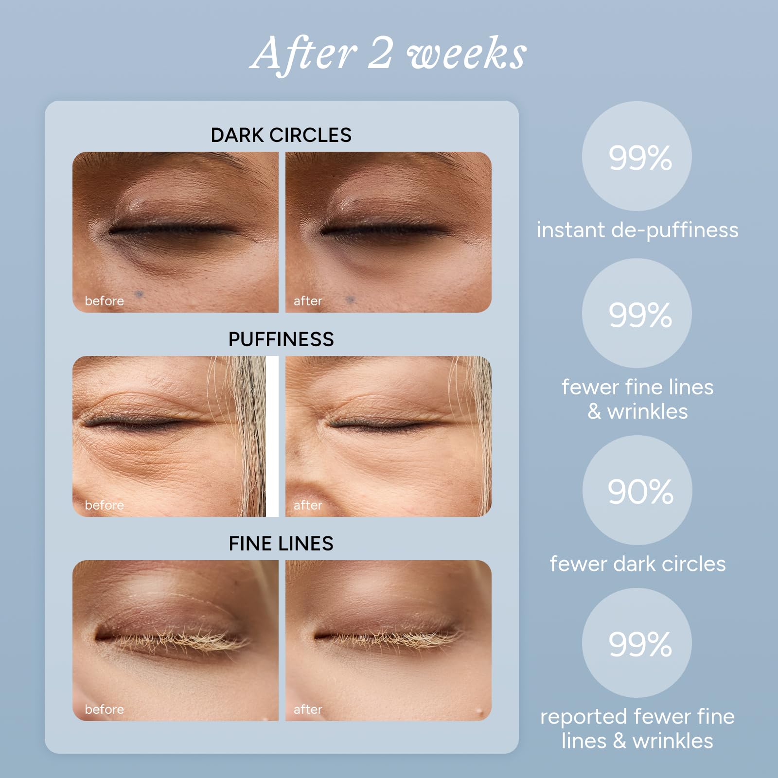 Caffeine & Hyaluronic Acid Under Eye Patches - 5 Pairs, 360° Coverage Targets Dark Circles, Puffy Eyes, Fine Lines & Eye Bags Hydrating Restoring Gel Eye Masks (PRO)