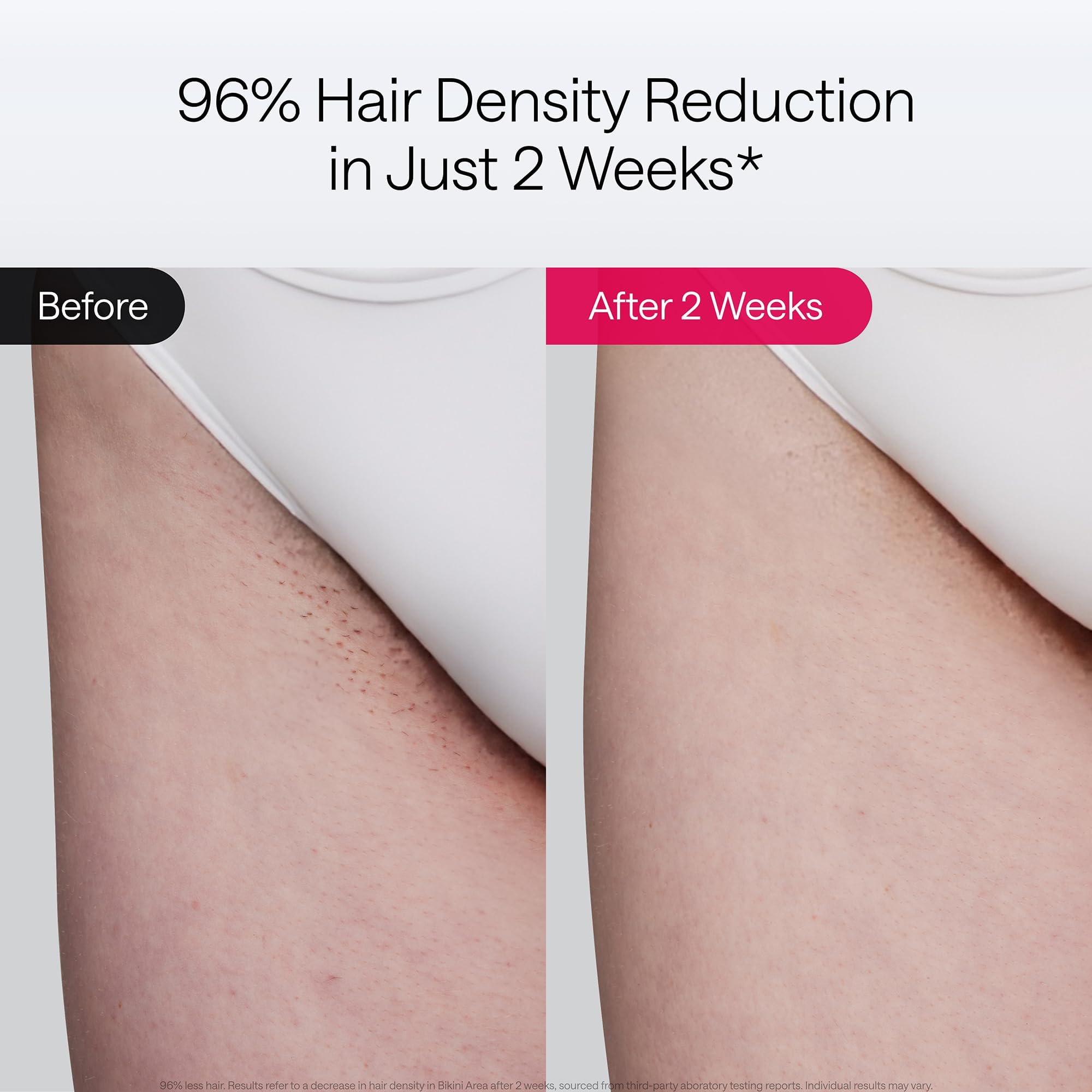 Ulike Laser Hair Removal Air 10 Deluxe Version IPL for for Women and Men with Ice-Cooling Technology, Nealy Painless and Permanent Hair Reduction, at Home Hair Removal in 10mins with Skin Sensor