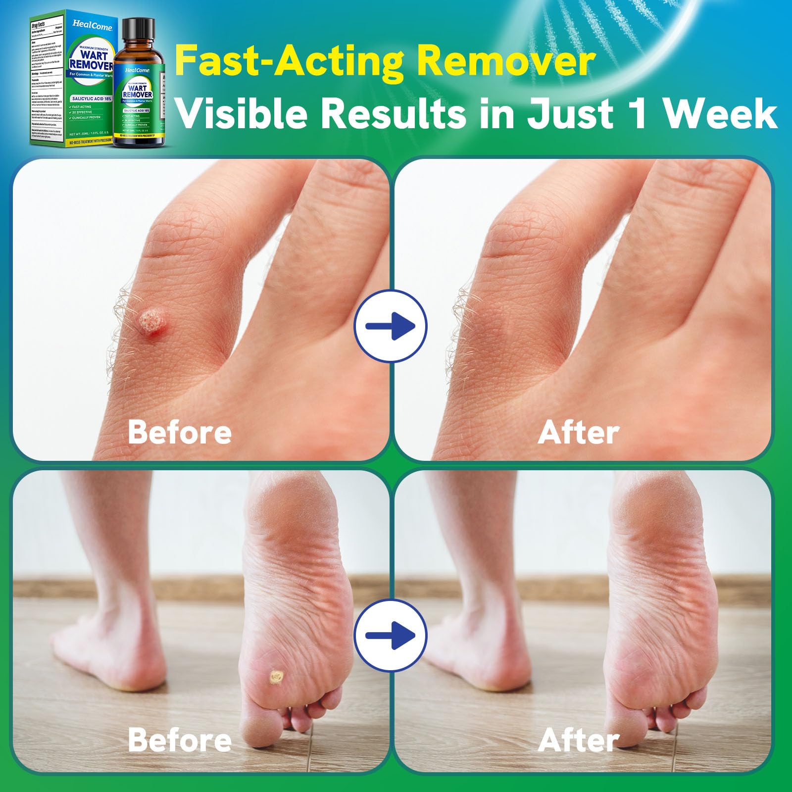 Healcome Wart Remover Fast Acting: 18% Salicylic Acid Maximum Strength Wart Remover - Effective and Painless Wart Removal for Plantar Common Flat Warts - Safe for Adults and Kids Over 4