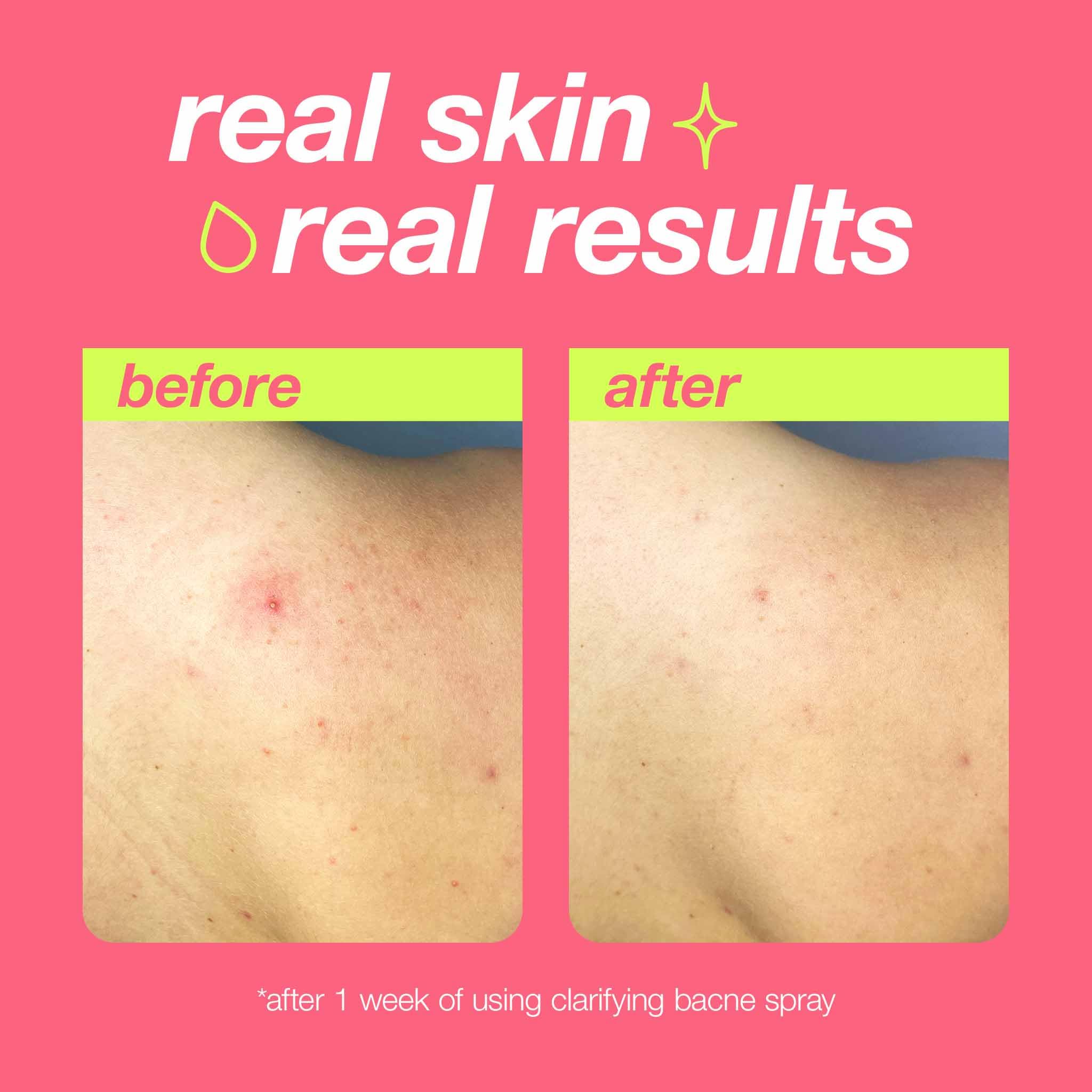 Dermalogica Clear Start Clarifying Bacne Spray, Back Acne Treatment Spray for Body Breakout - Pore Clearing, Preventing Pimple with Salicylic Acid, Witch Hazel, Tea Tree Oil, All Skin Type, 6 fl oz