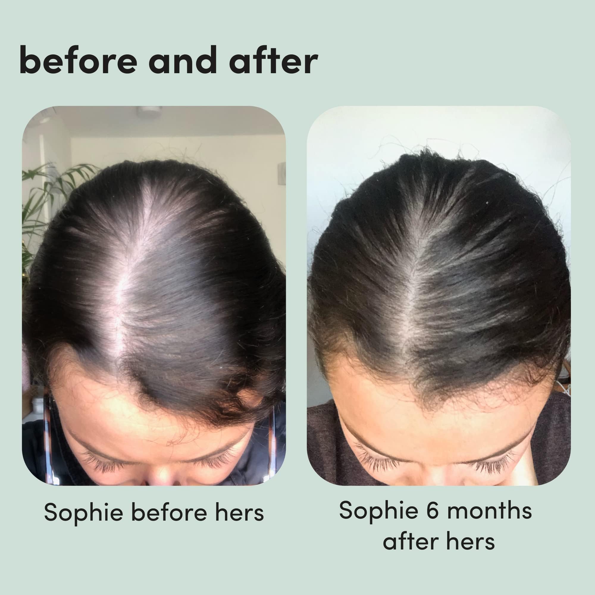 hers Hair Regrowth Treatment - Topical Minoxidil 5% Foam for Women - Extra Strength - Supports Thicker, Fuller Hair - Non-Greasy - Unscented, 2 Pack