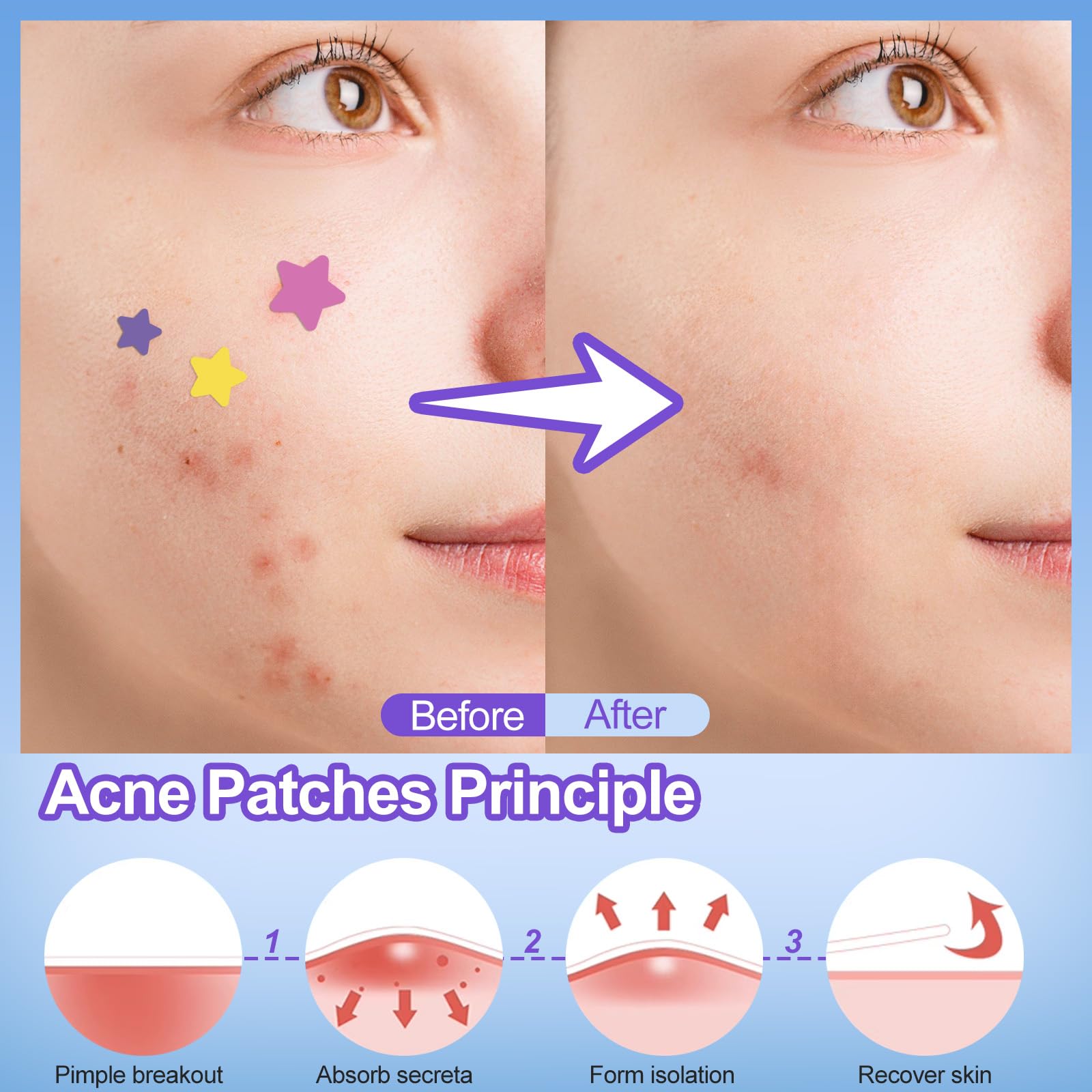 JIANLANPTT Pimple Patches for Face, 276 Pack Acne Patches, Hydrocolloid Pimple Patches for Covering Zits and Blemishes, Pimple Zit Patches with Tea Tree Oil, Salicylic Acid and Centella Asiatic
