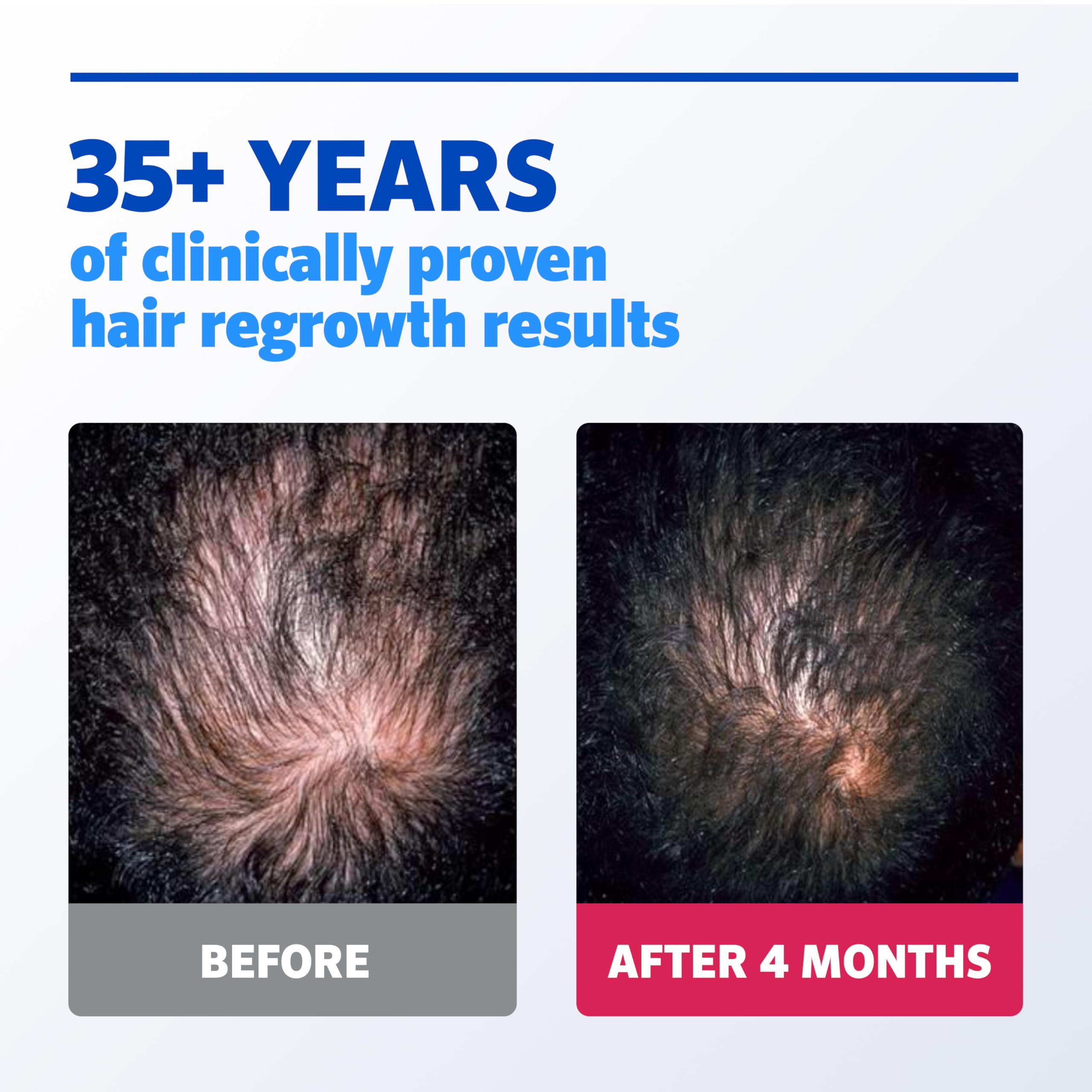 Men's Rogaine Extra Strength 5% Minoxidil Solution, 3 Mo Supply, 3x 2 Fl Oz