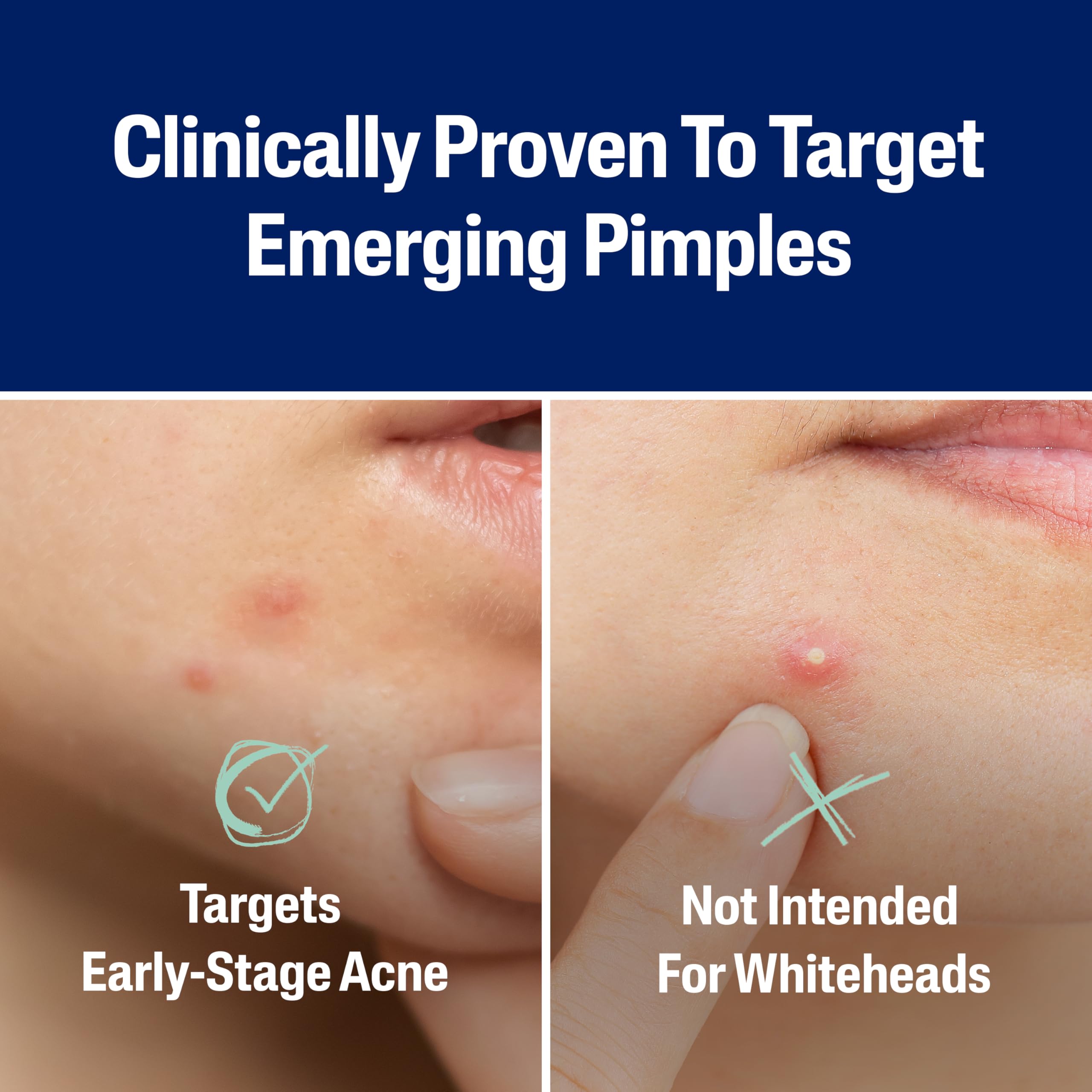 Cetaphil Acne Patches, Pimple Patches for Sensitive Skin, Formulated with Salicylic Acid, CICA, and Heartleaf Extract for Emerging Pimples, Visible Results in 6 Hours, 24 Count