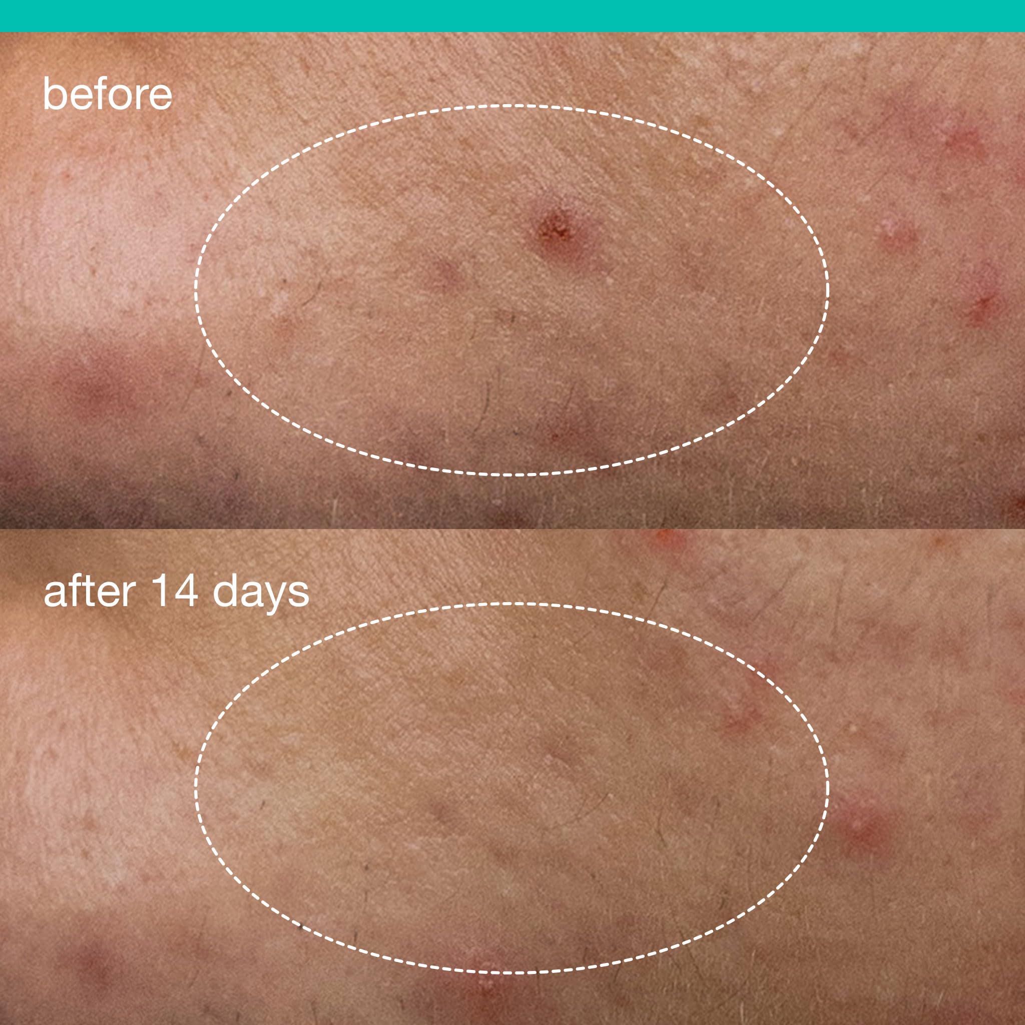 Dermalogica Deep Acne Liquid Patch, Invisible Spot Treatment for Pimple and Blemishes, Liquid to Patch Type Skin Soothing Clearing and Preventing Breakouts, Sulfur Based - 0.5 fl oz