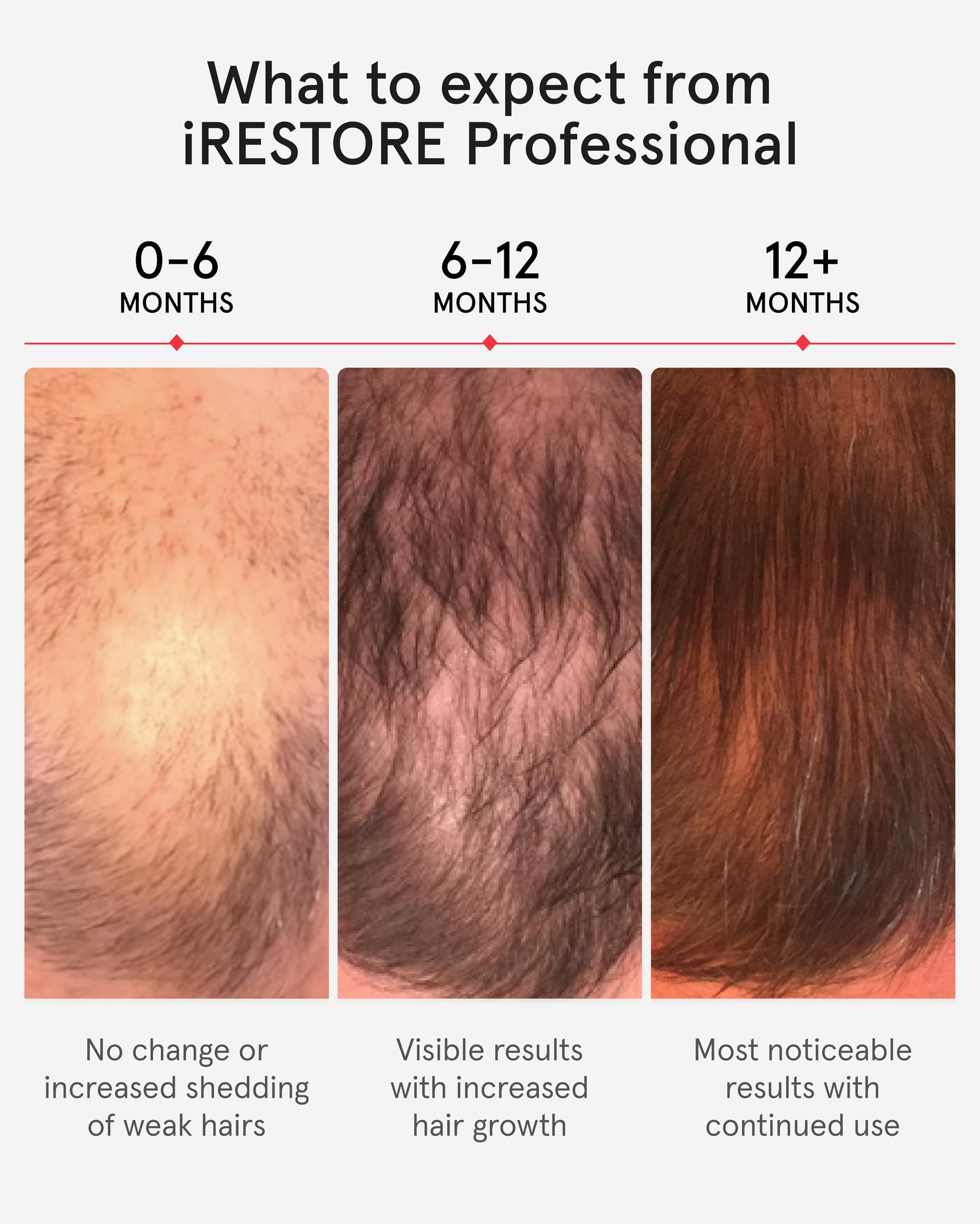iRestore Professional Laser Red Light Therapy for Hair Growth System - FDA Cleared Hair Loss, Hair Thinning & Alopecia Treatment for Men & Women - 282 Lasers & LEDs
