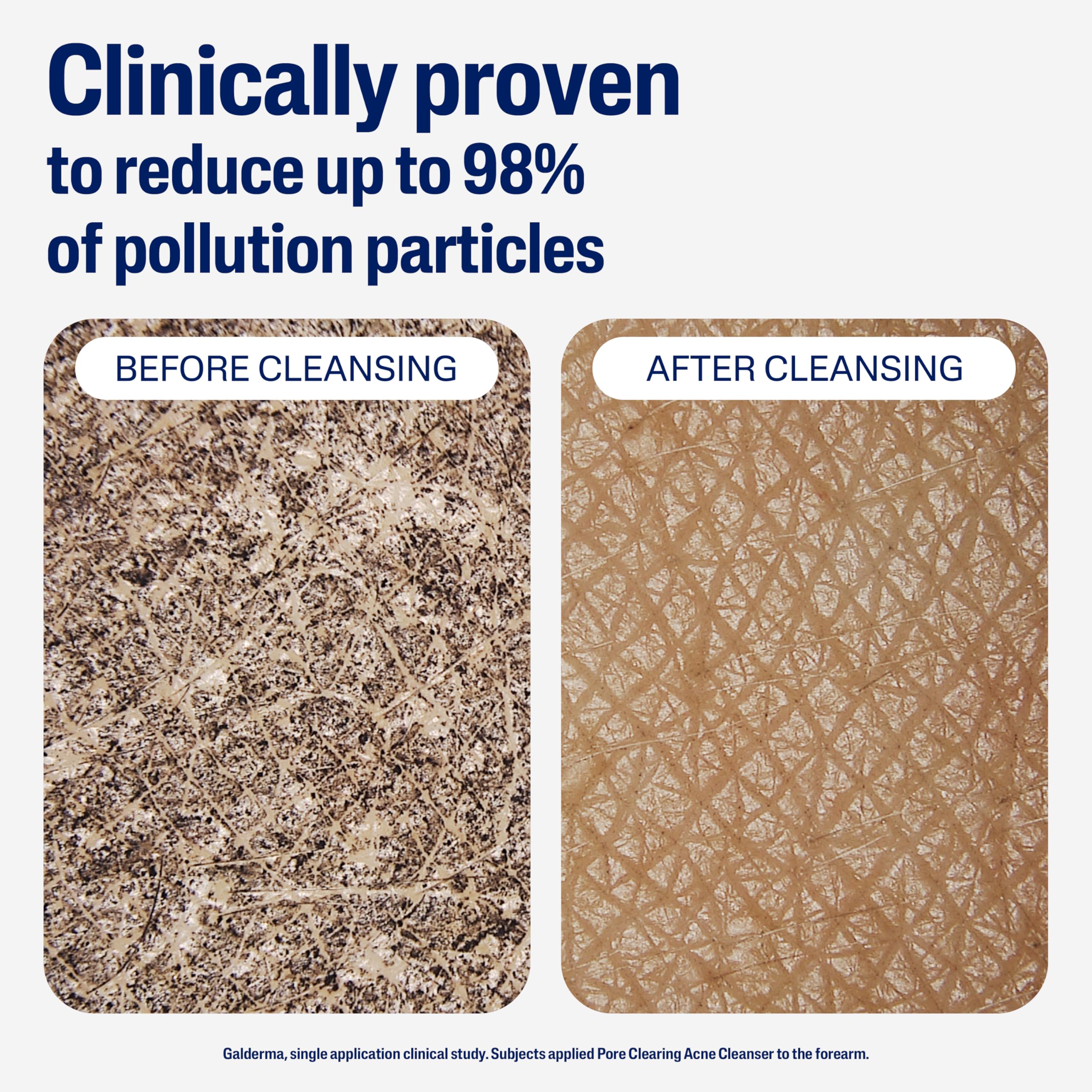 Cetaphil Gentle Clear Pore Clearing Acne Cleanser, Foaming Gel Cleanser for Sensitive, Acne-Prone Skin, 8 Fl Oz Pump Bottle, 2% Salicylic Acid, Gently Exfoliates, Dermatologist Recommended Brand