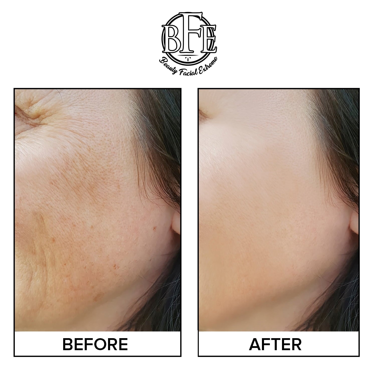 Beauty Facial Extreme Anti-Aging Resurfacing Peel Pads